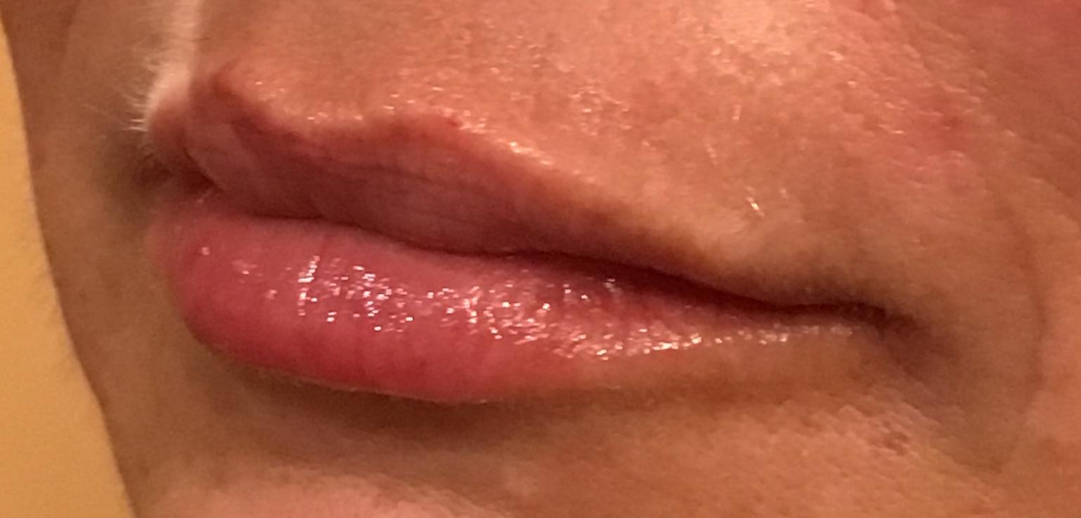 Lips-after