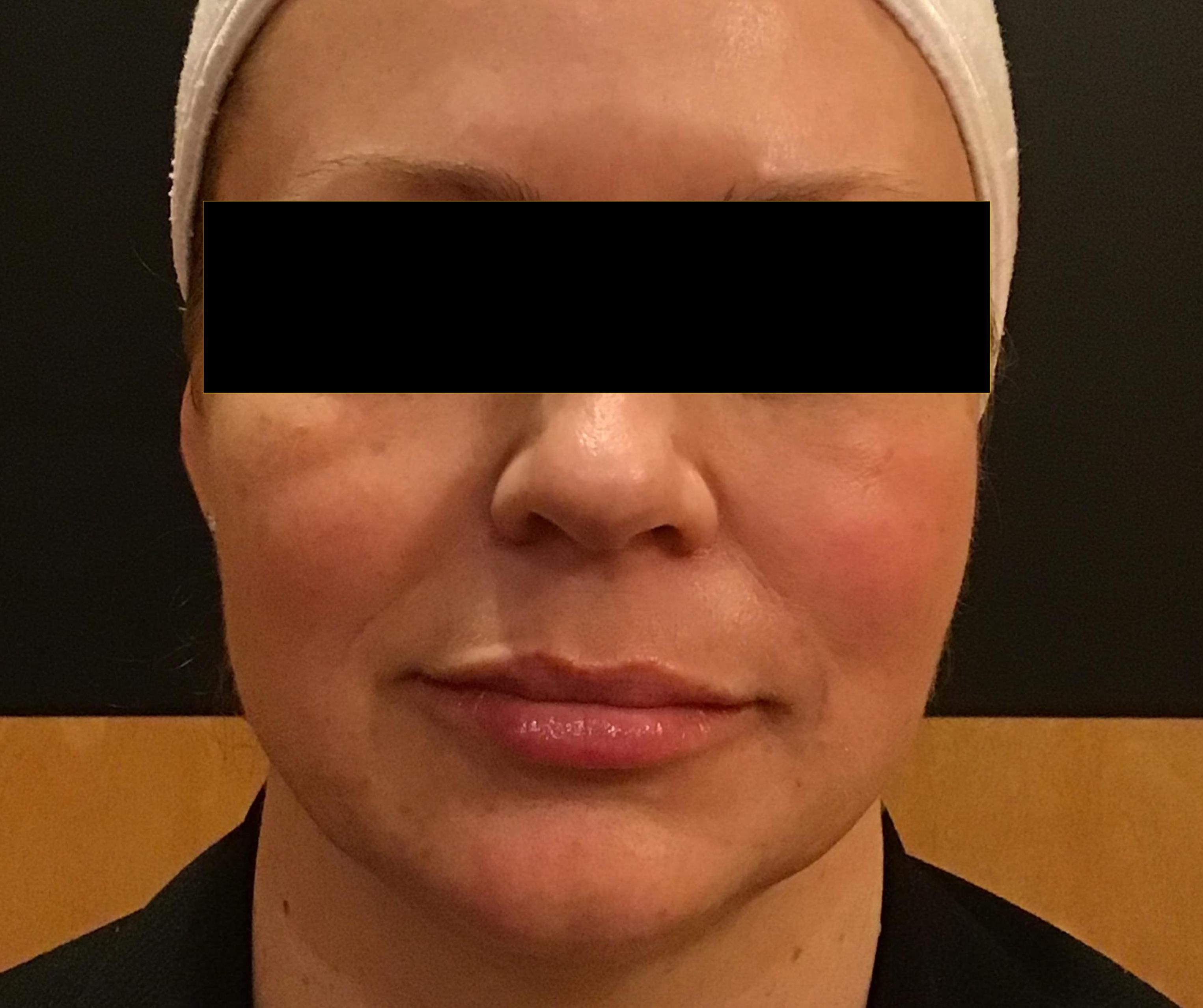 Cheeks, Jawline & Lips-after