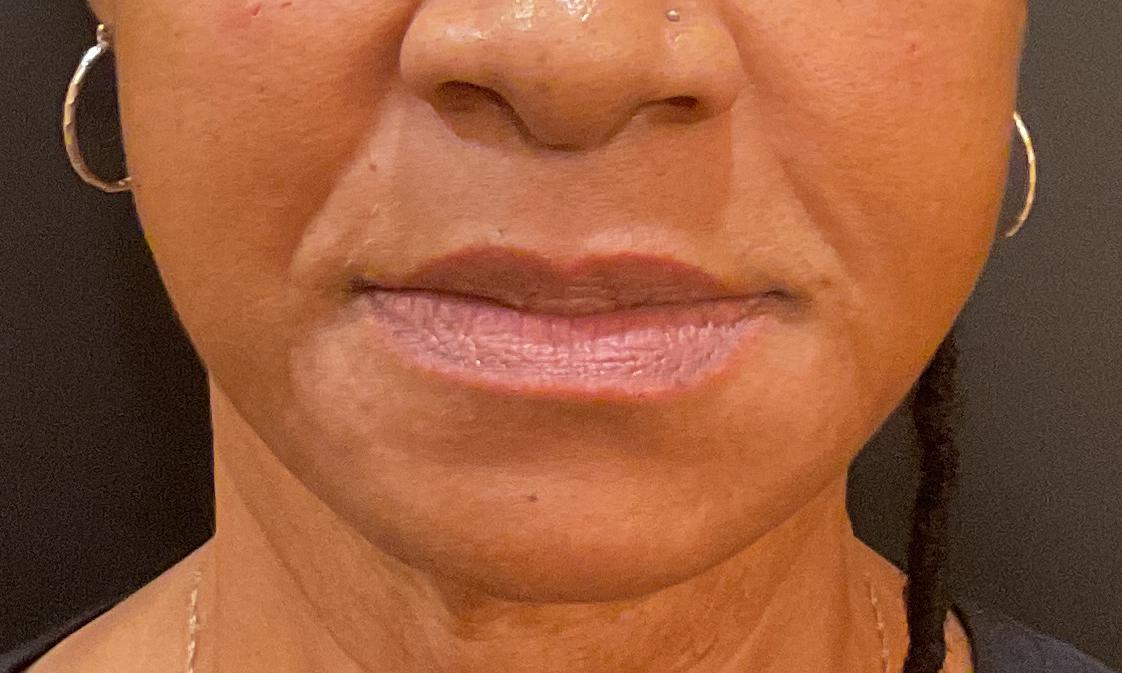 Nasolabial-after