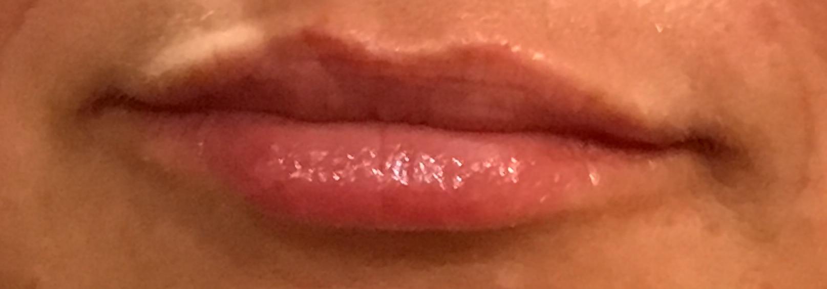 Lips-after