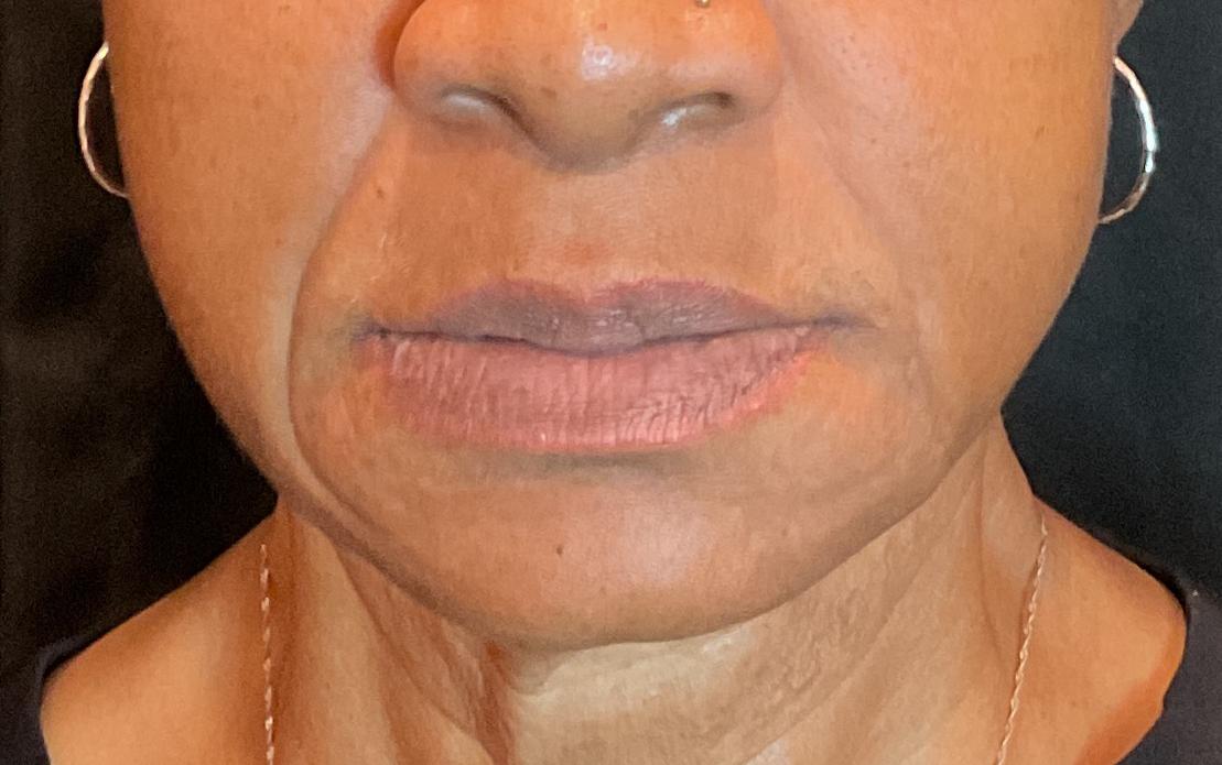 Nasolabial-before