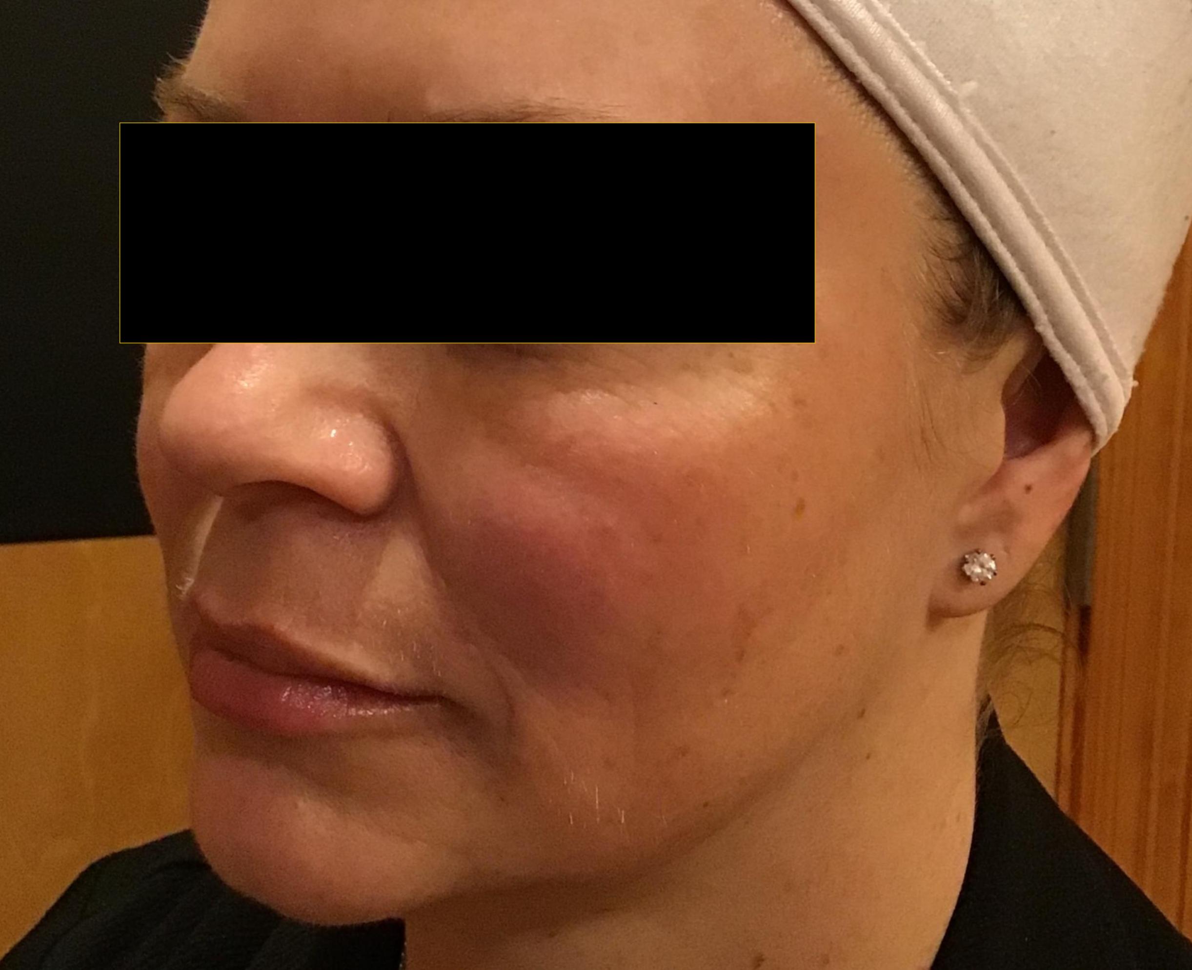 Cheeks, Jawline & Lips-after