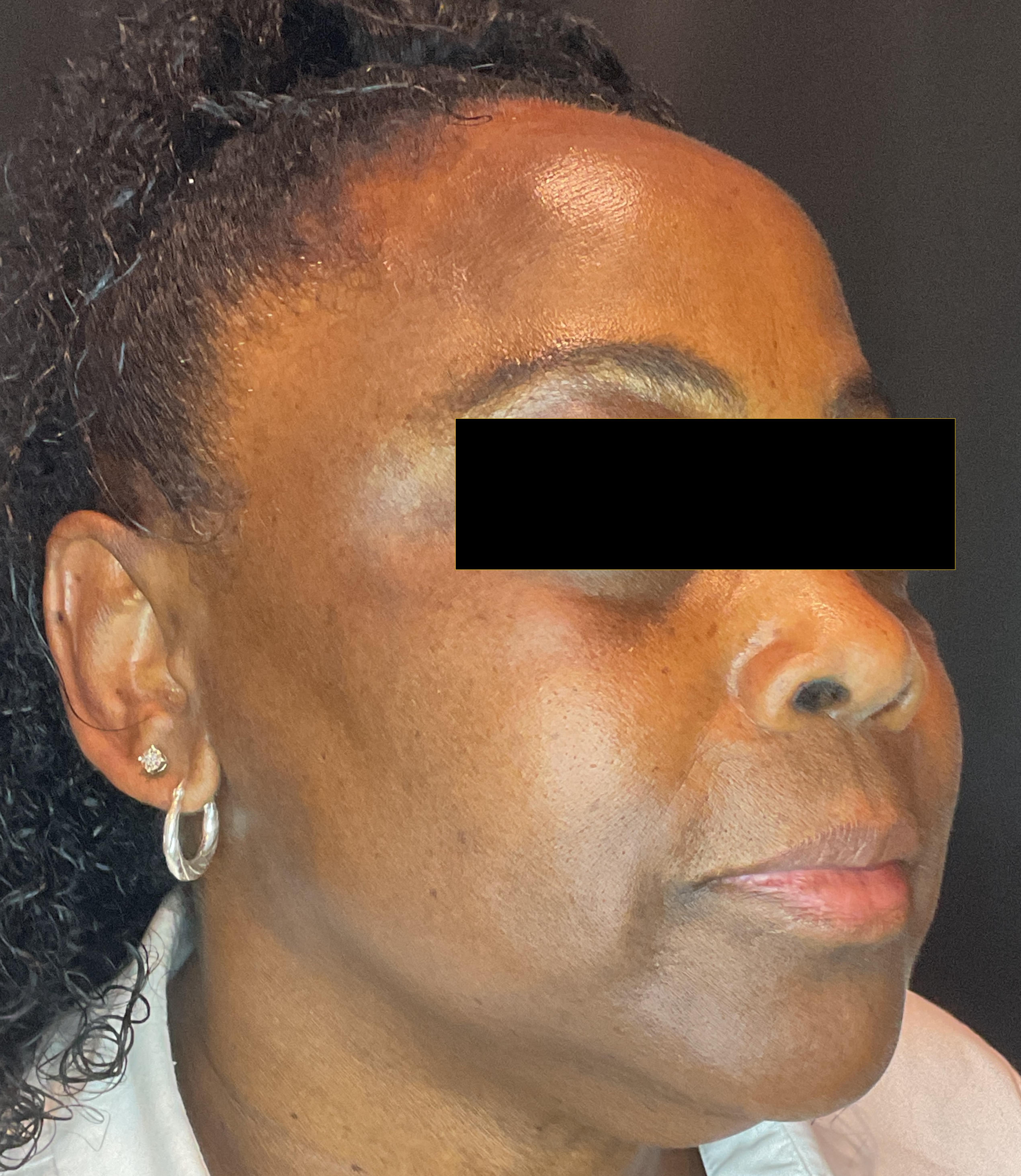 NeoSkin w/ ChemPeel for Hyperpigmentation-after