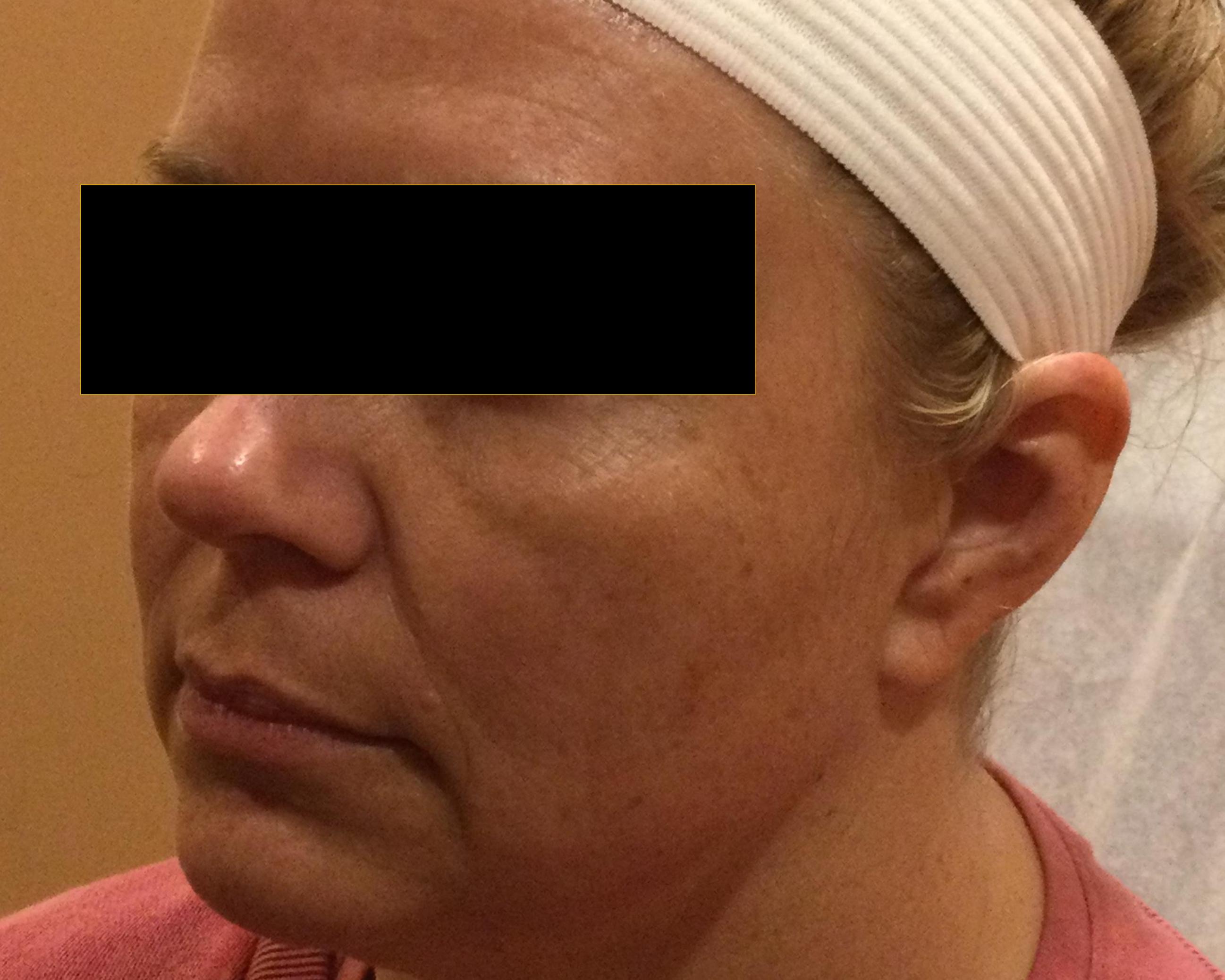 Cheeks, Jawline & Lips-before