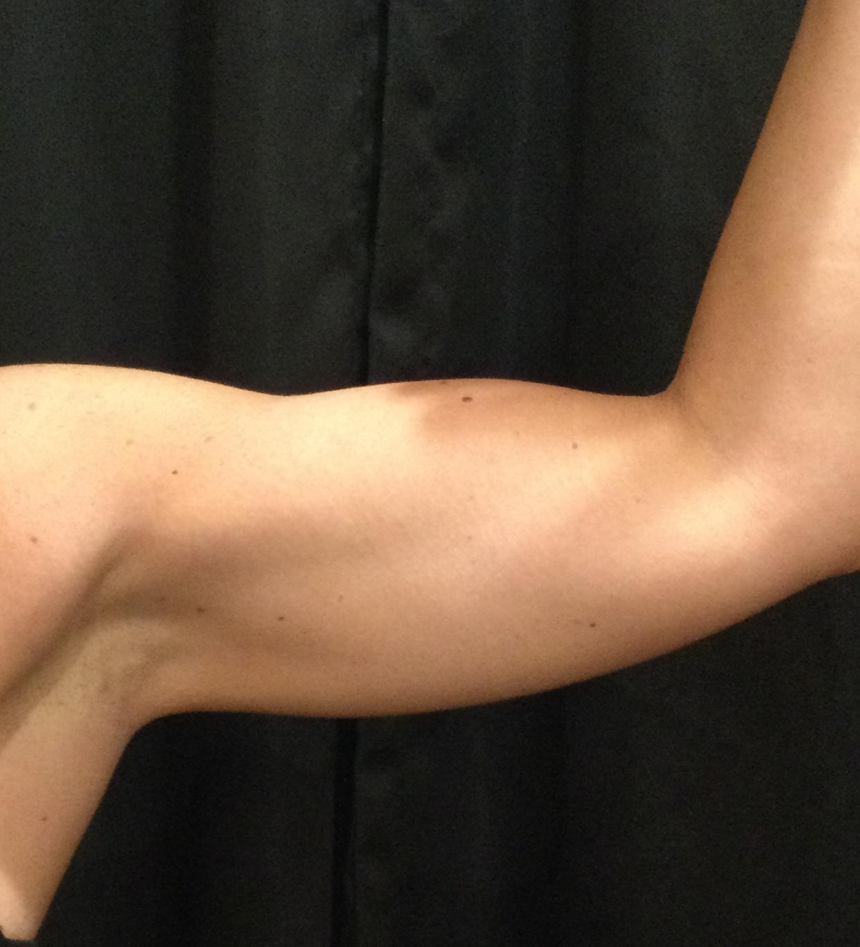 After 3 months (2 Treatments)-after