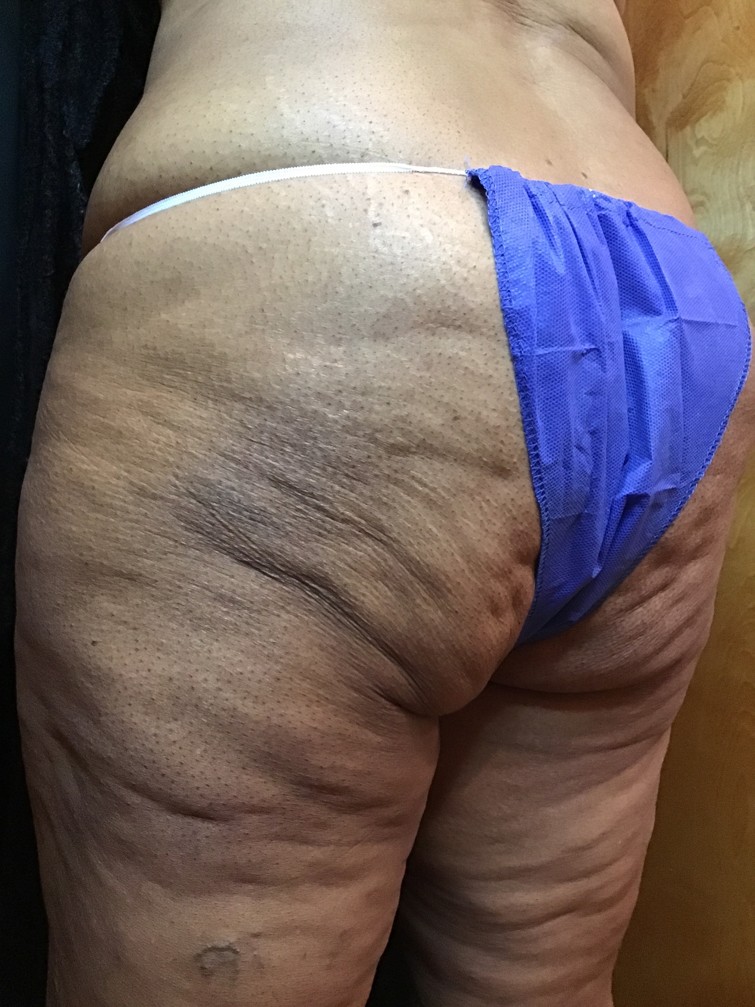 3 Treatments Morpheus Body-before