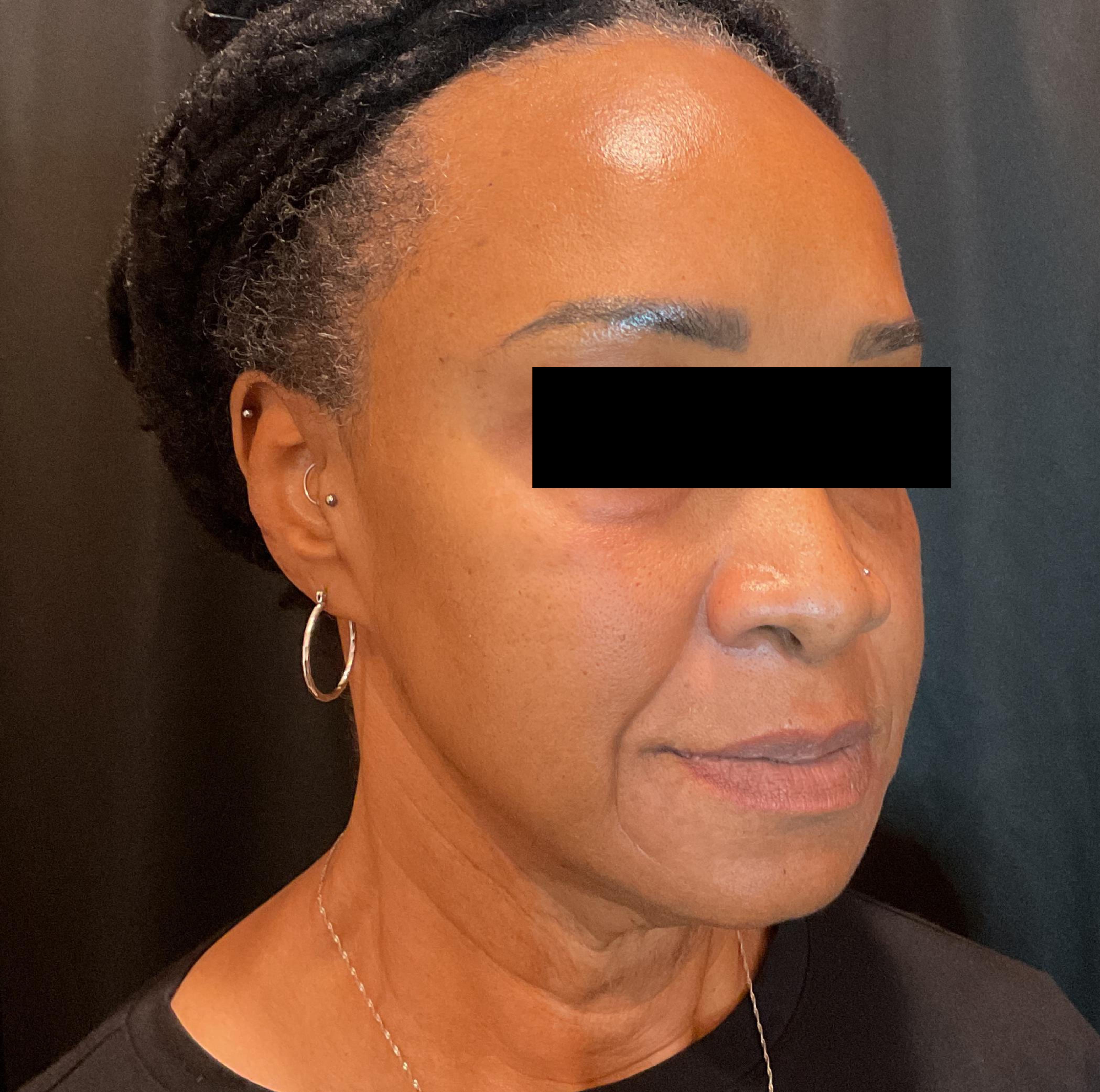 Nasolabial Folds & Cheeks-before