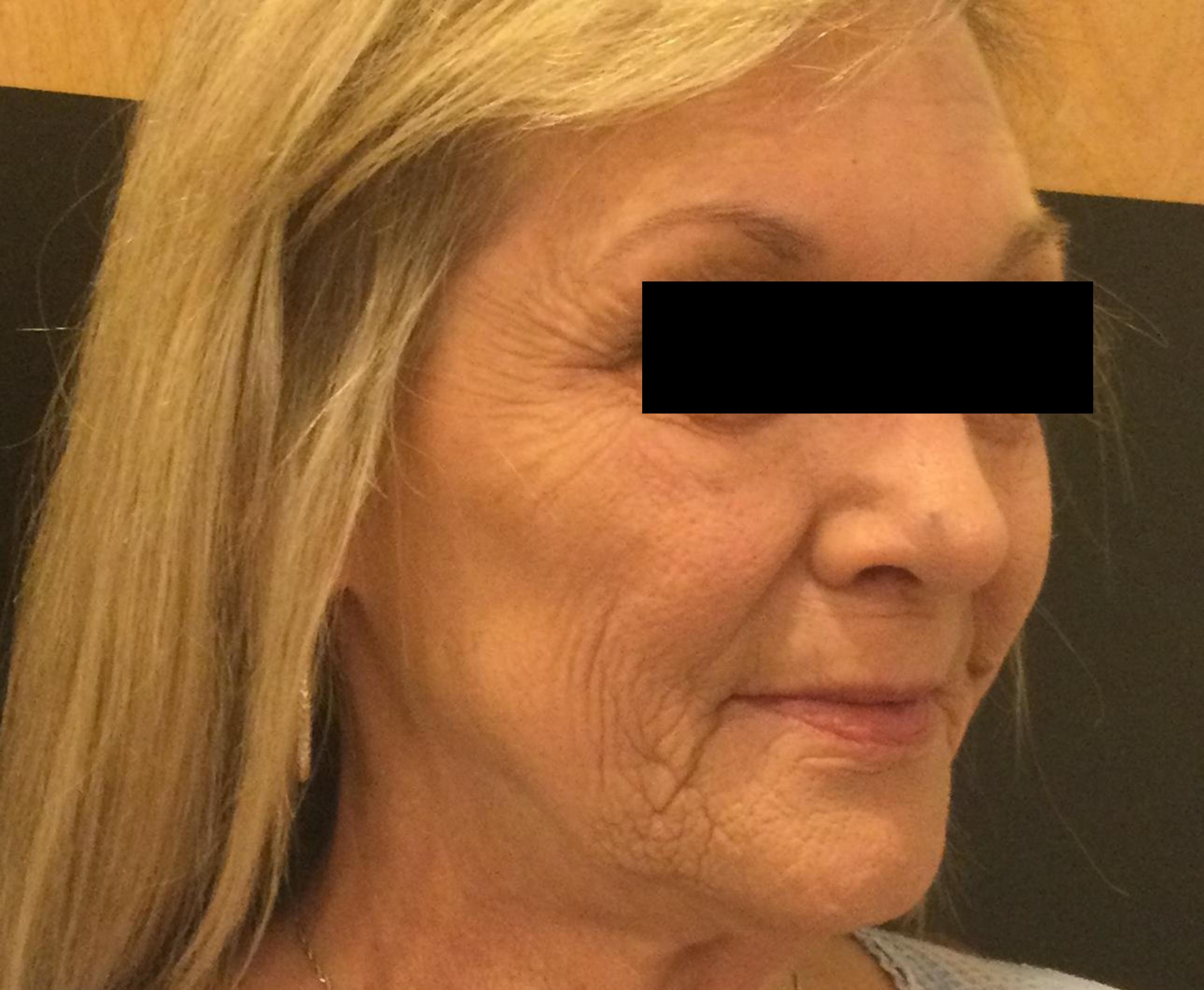 Juvéderm & Plasma Pen Combination-before