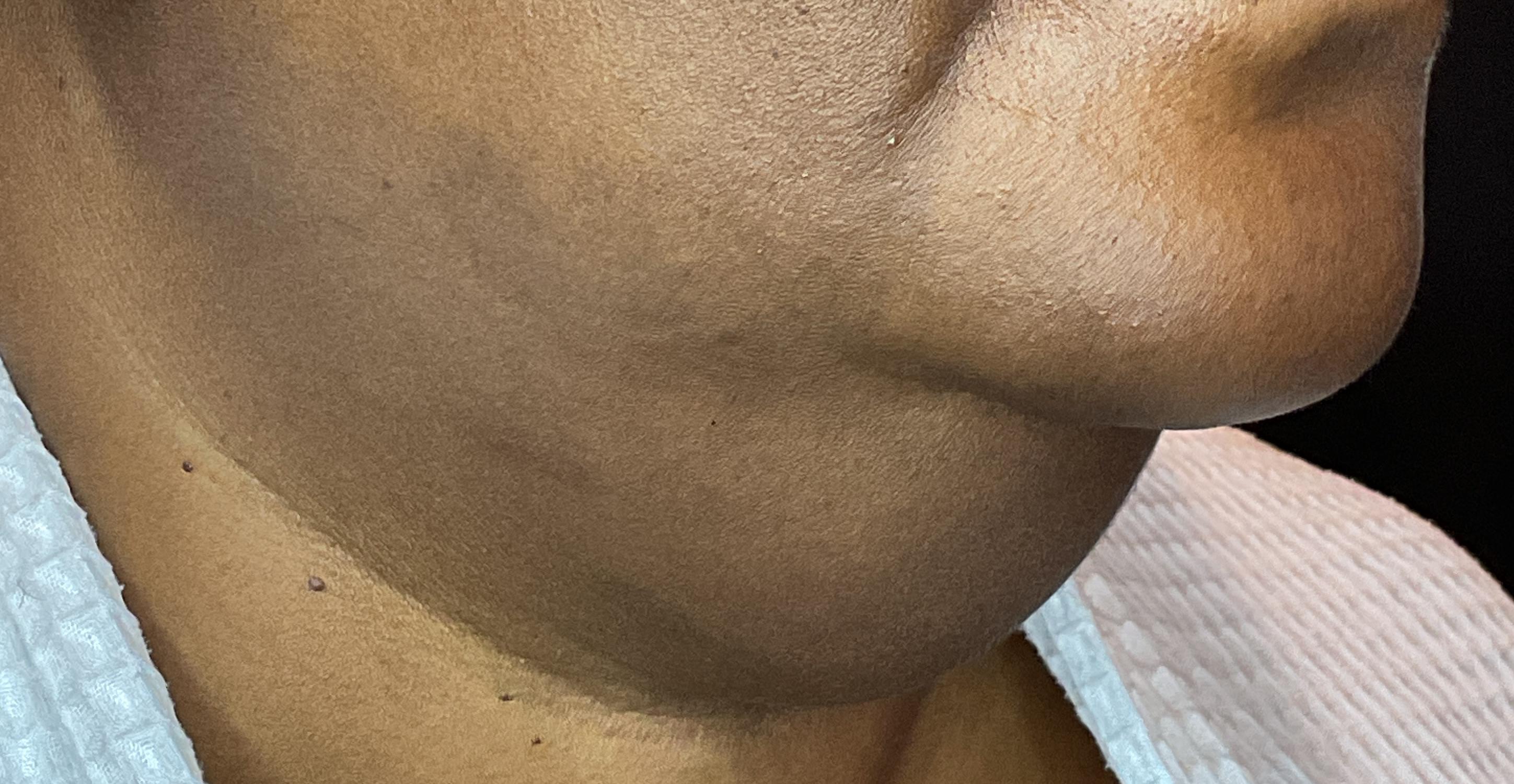 One Treatment, One Month Follow Up-before