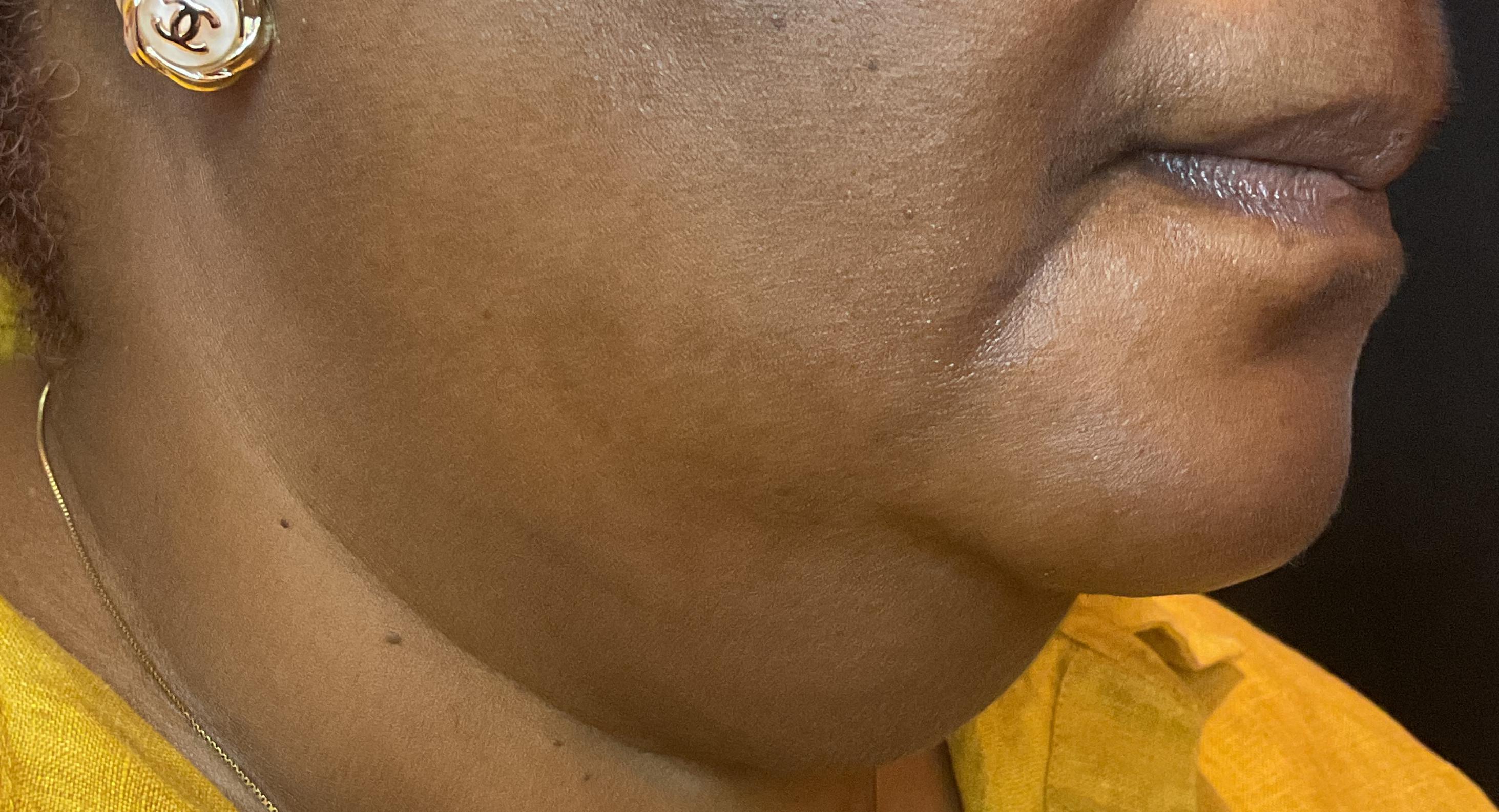 One Treatment, One Month Follow Up-after