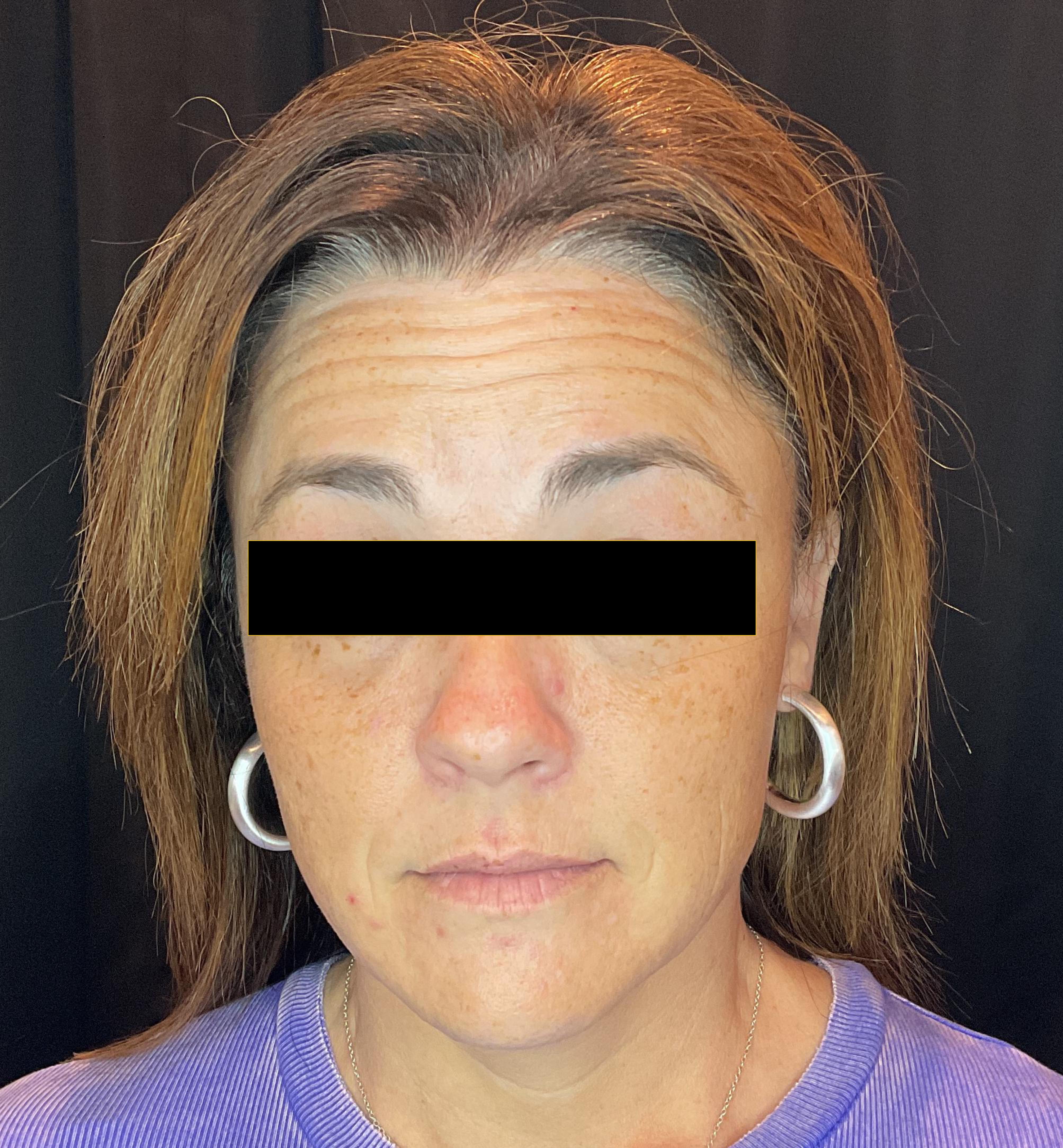 Two week follow up-before