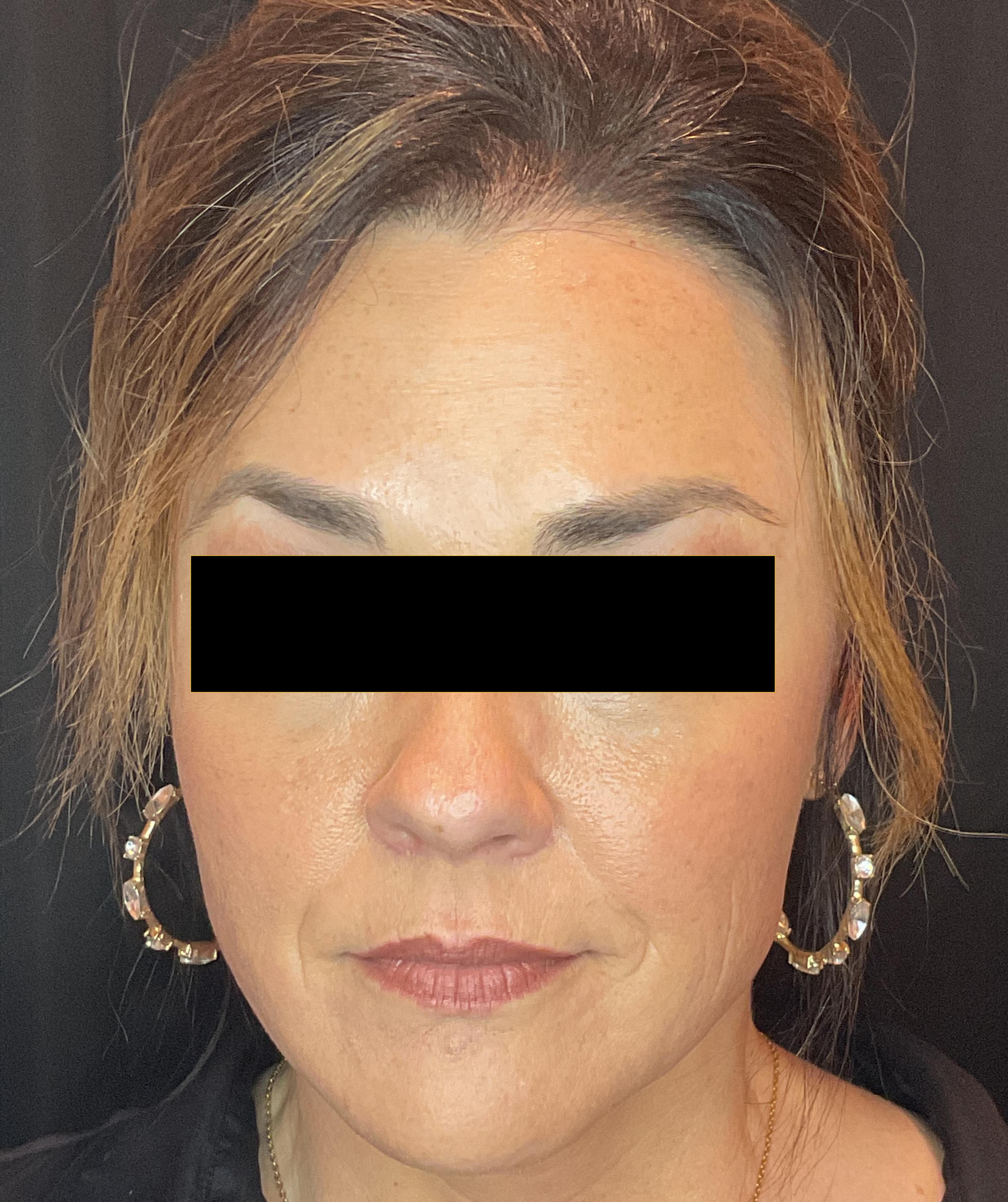 Two week follow up-after