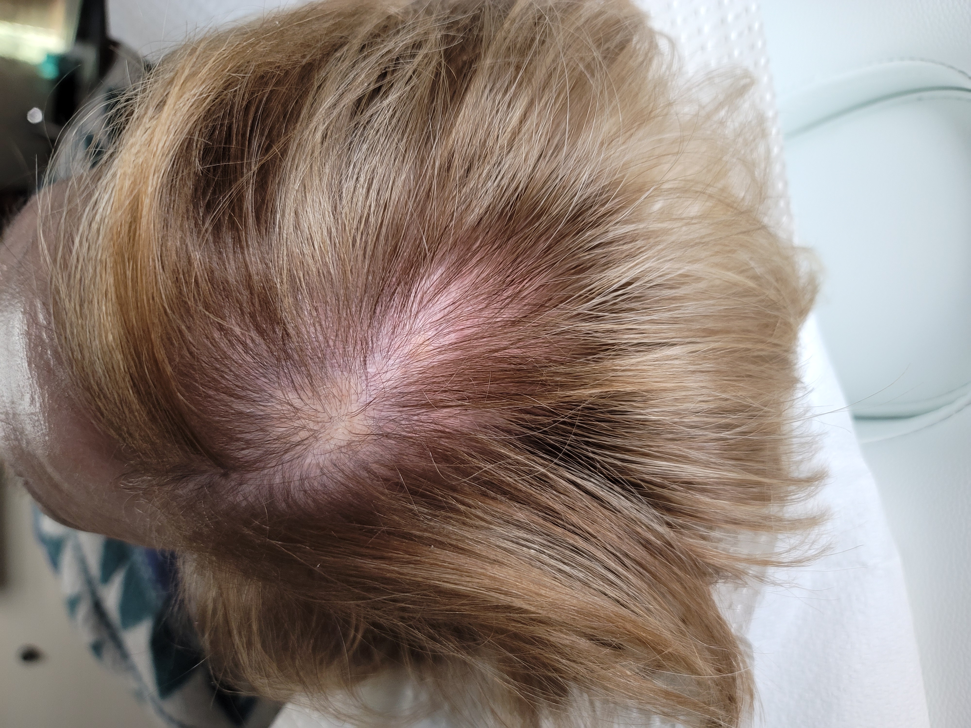 After 1 Hair PRP Treatment-after