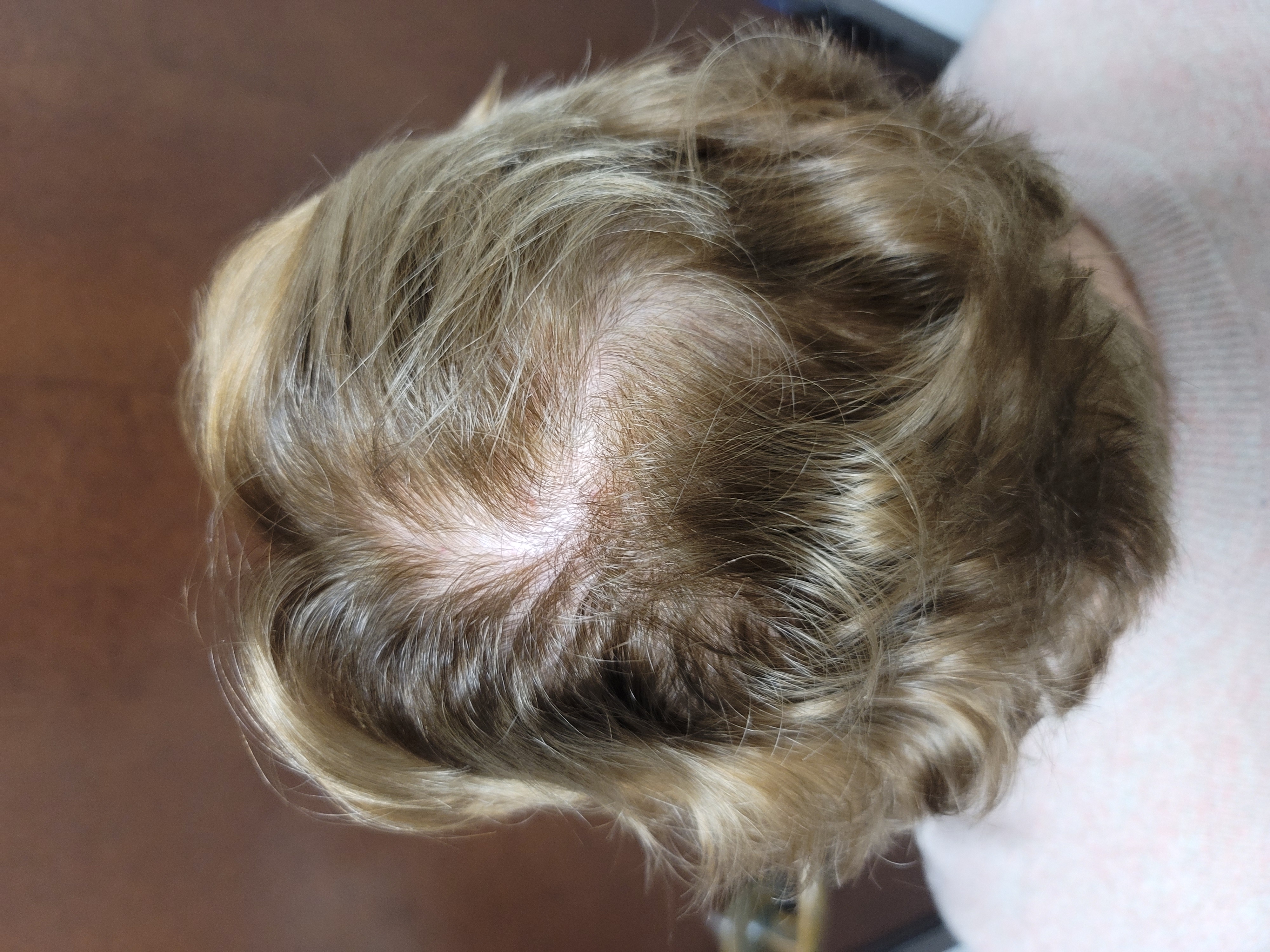 After 1 Hair PRP Treatment-before