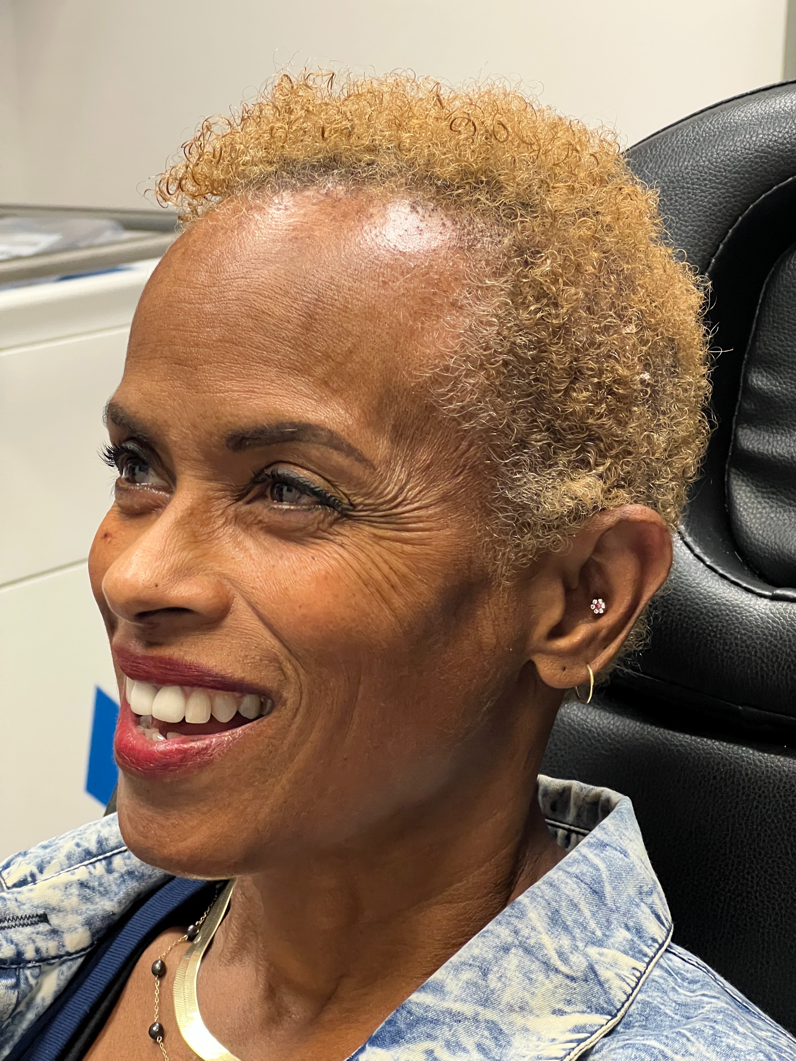 Ashley Reich RN. Treated with Jeuveau-before