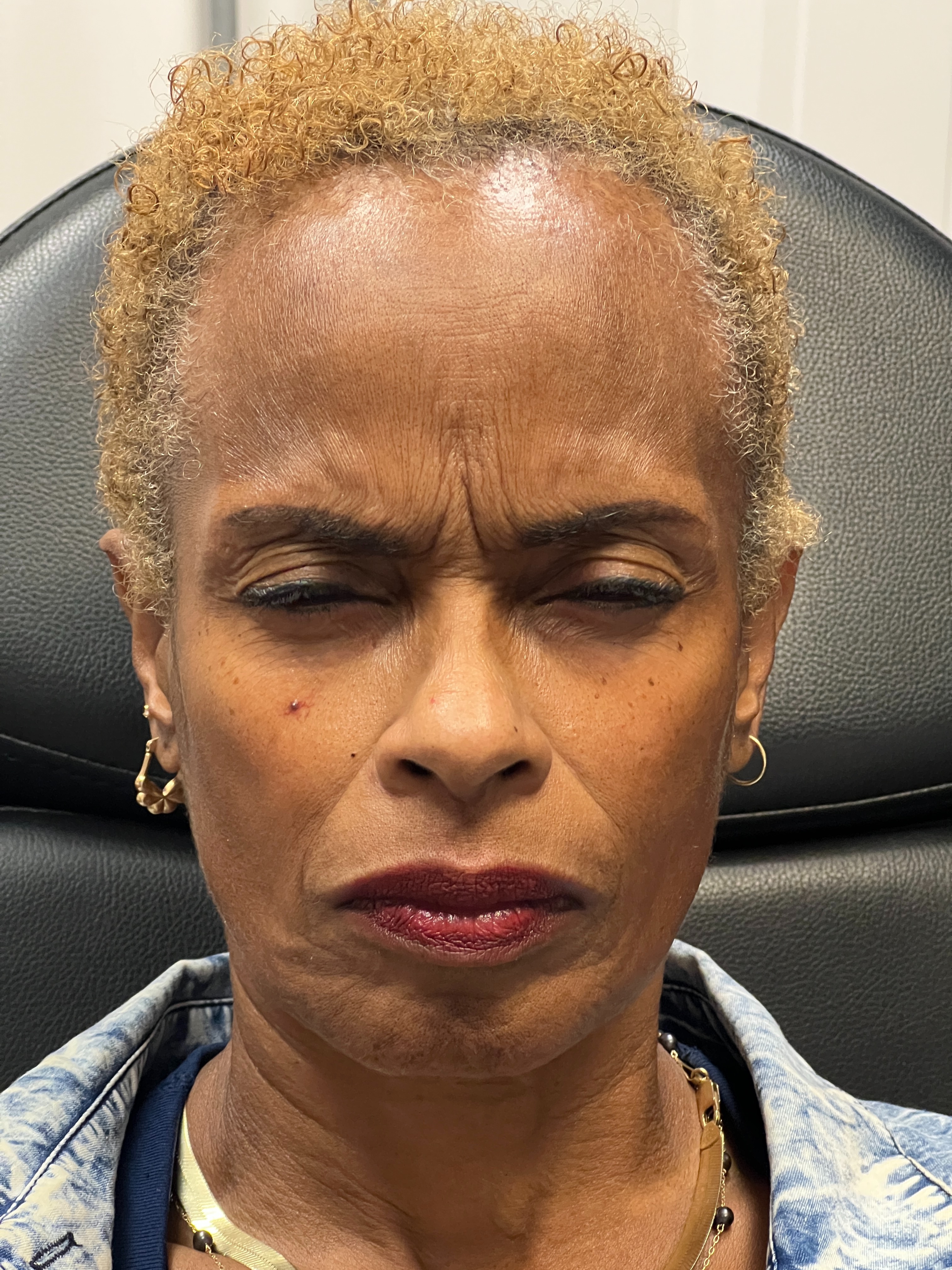 Ashley Reich RN. Treated with Jeuveau.-before