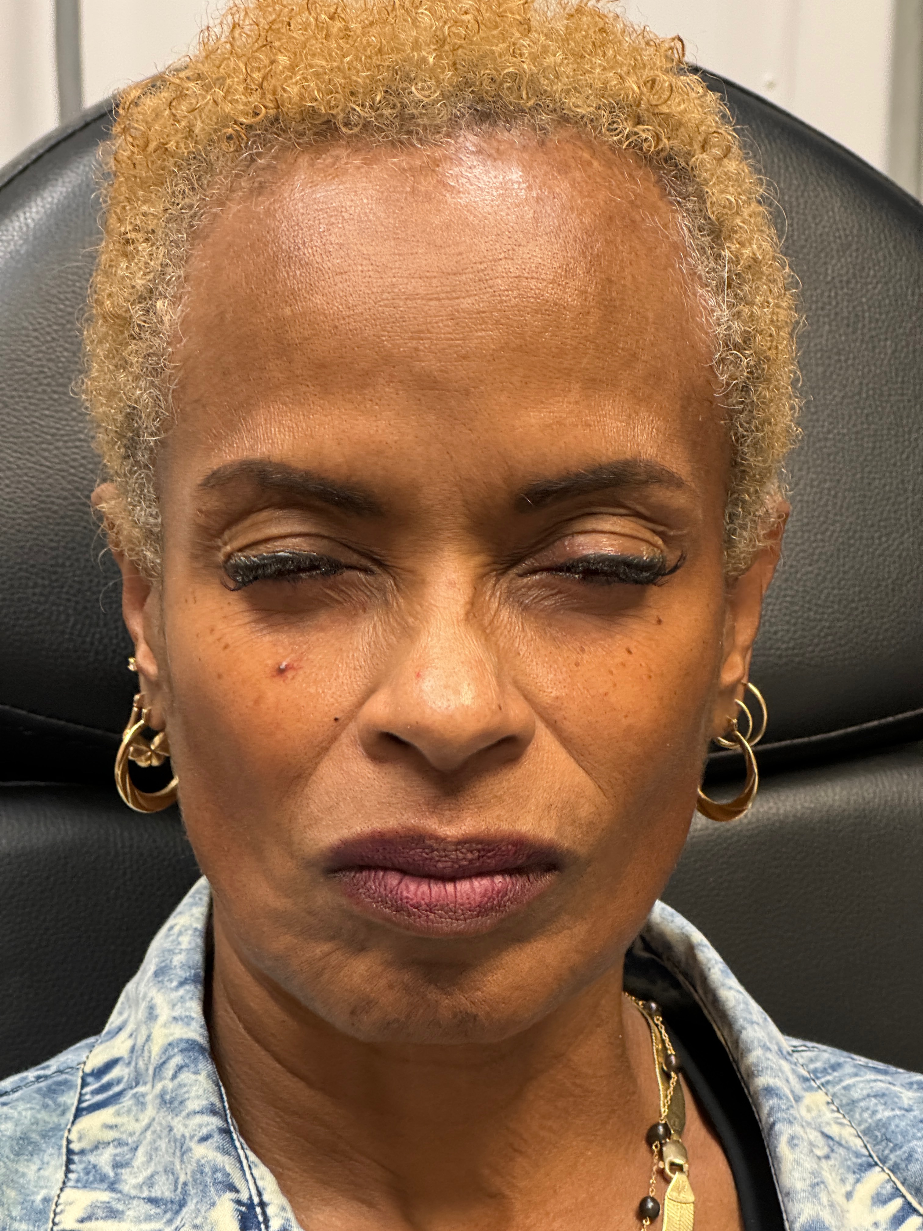 Ashley Reich RN. Treated with Jeuveau.-after