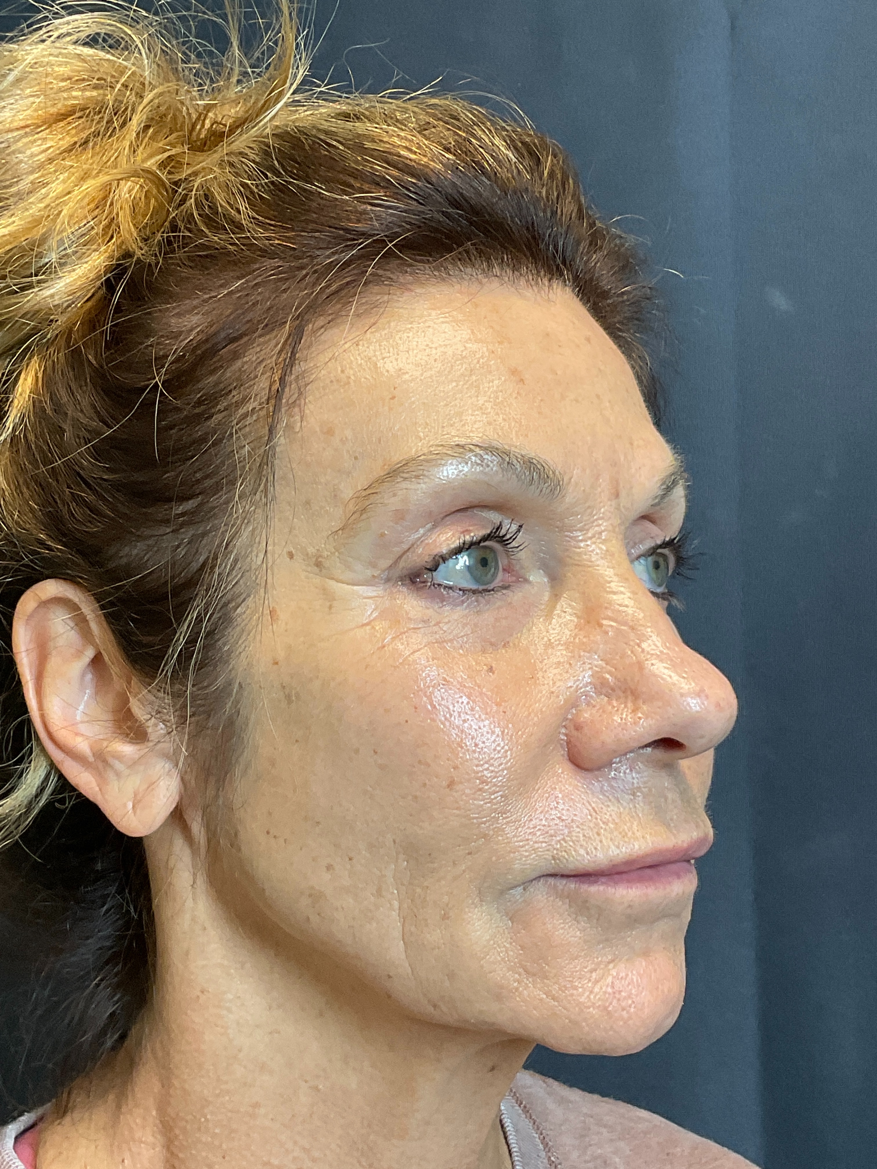 10 days-after