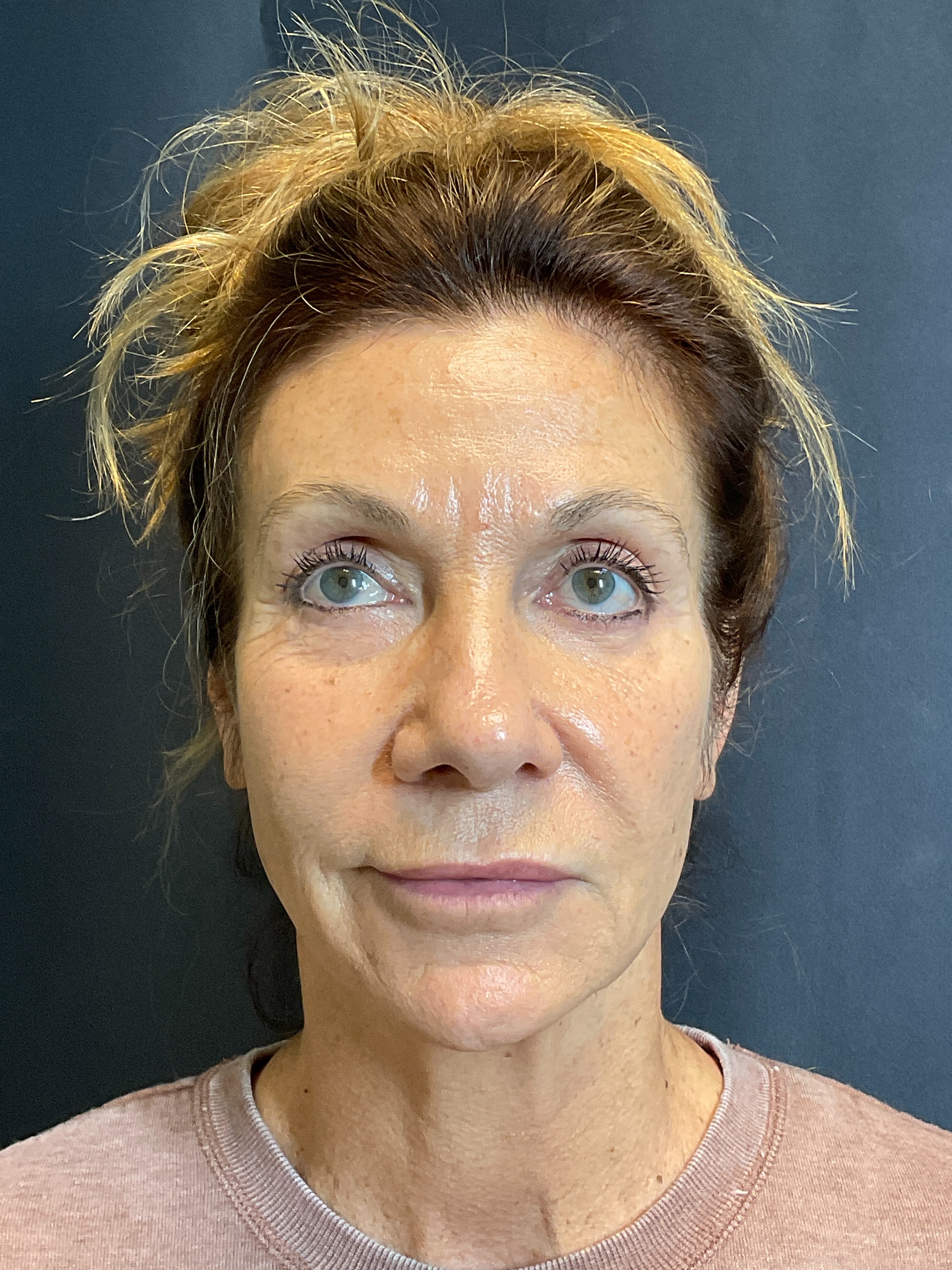 10 days-after