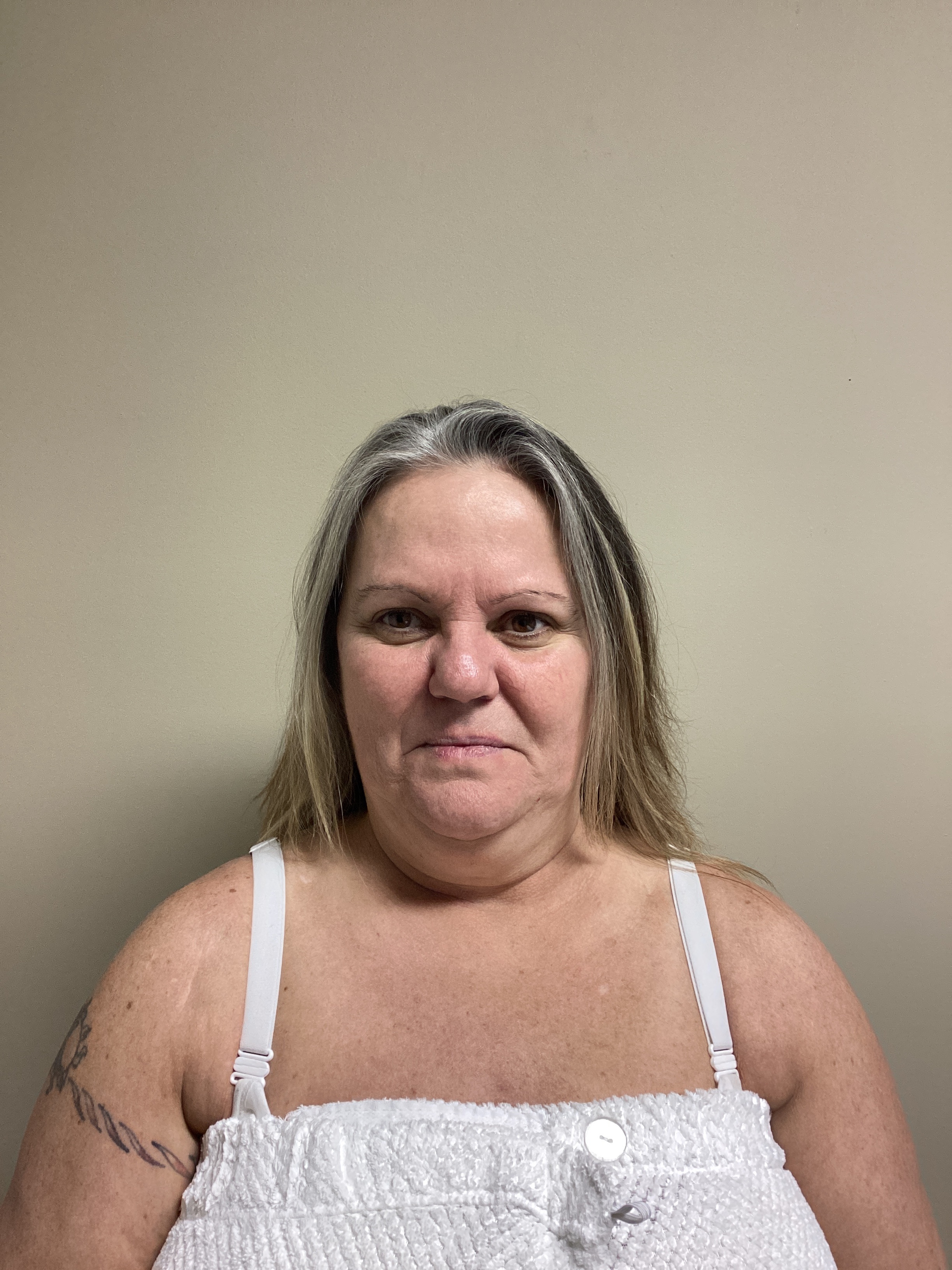 1 Treatment! -AJ-before