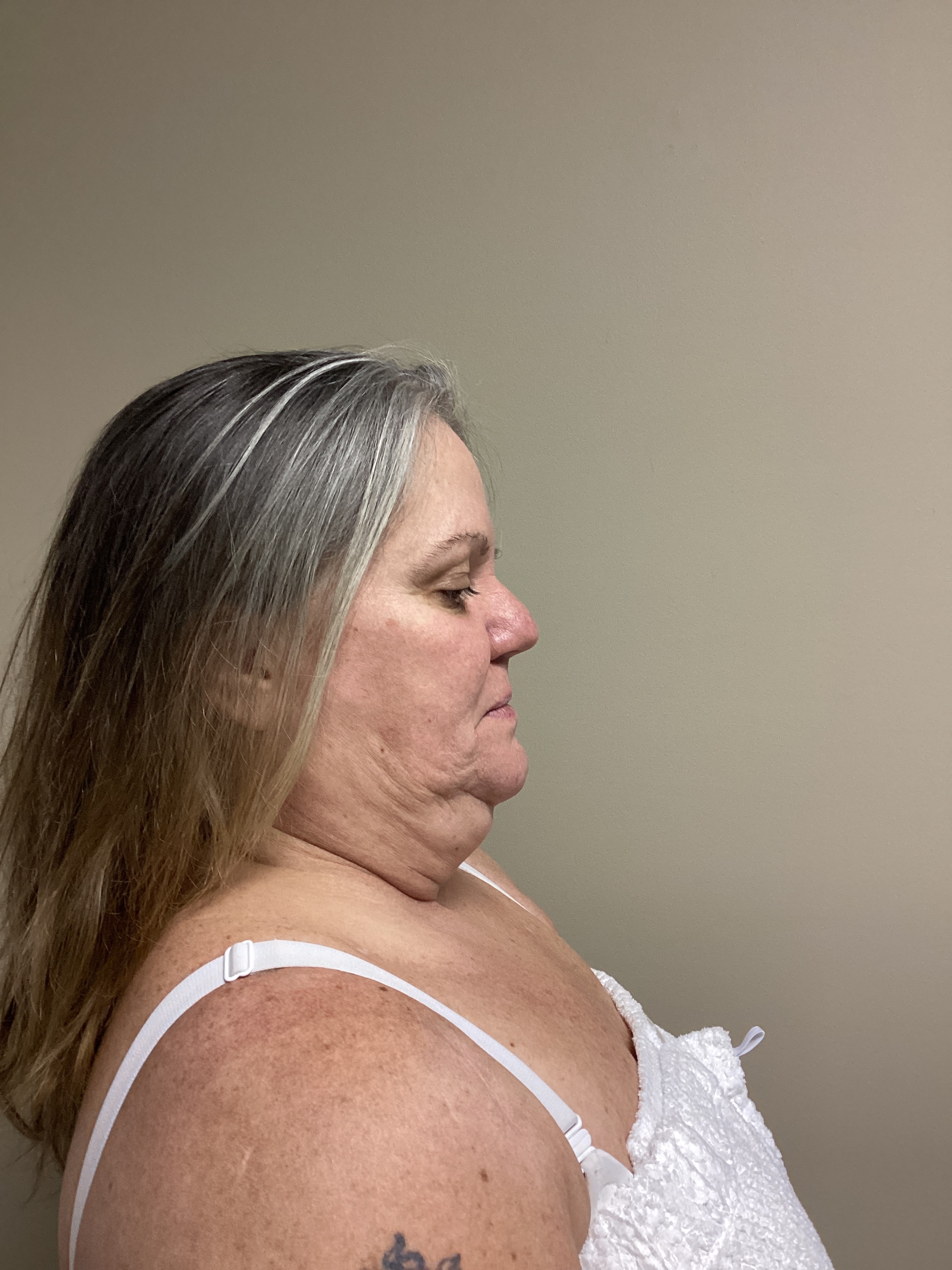 1 Treatment! -AJ-before