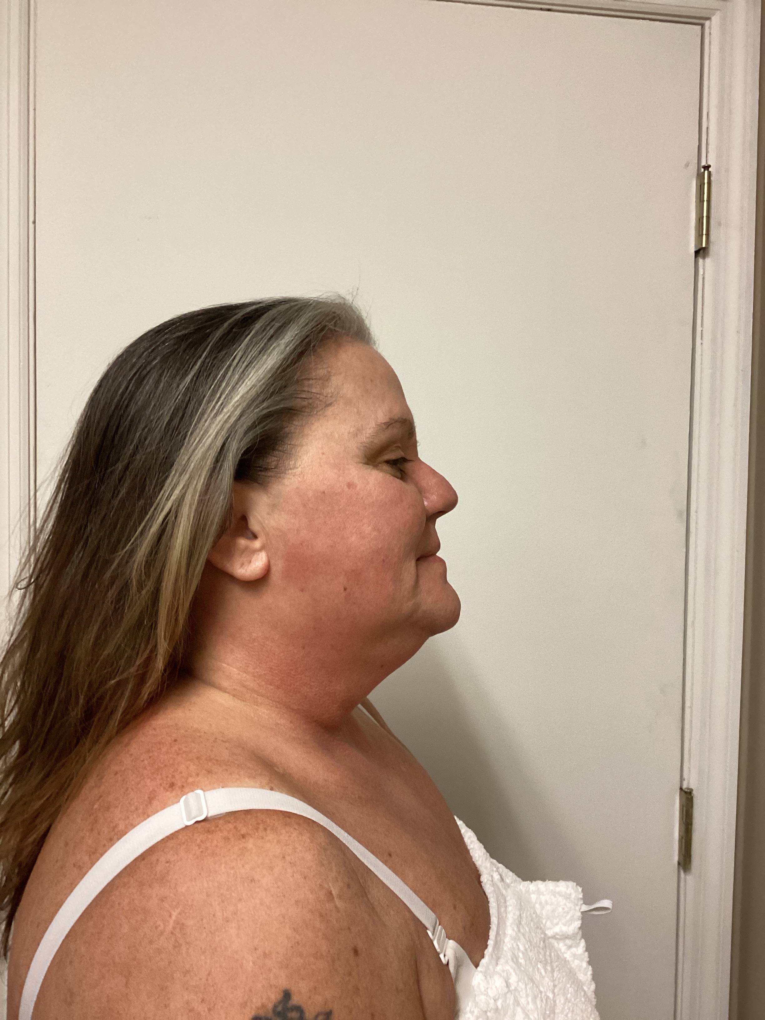 1 Treatment! -AJ-after