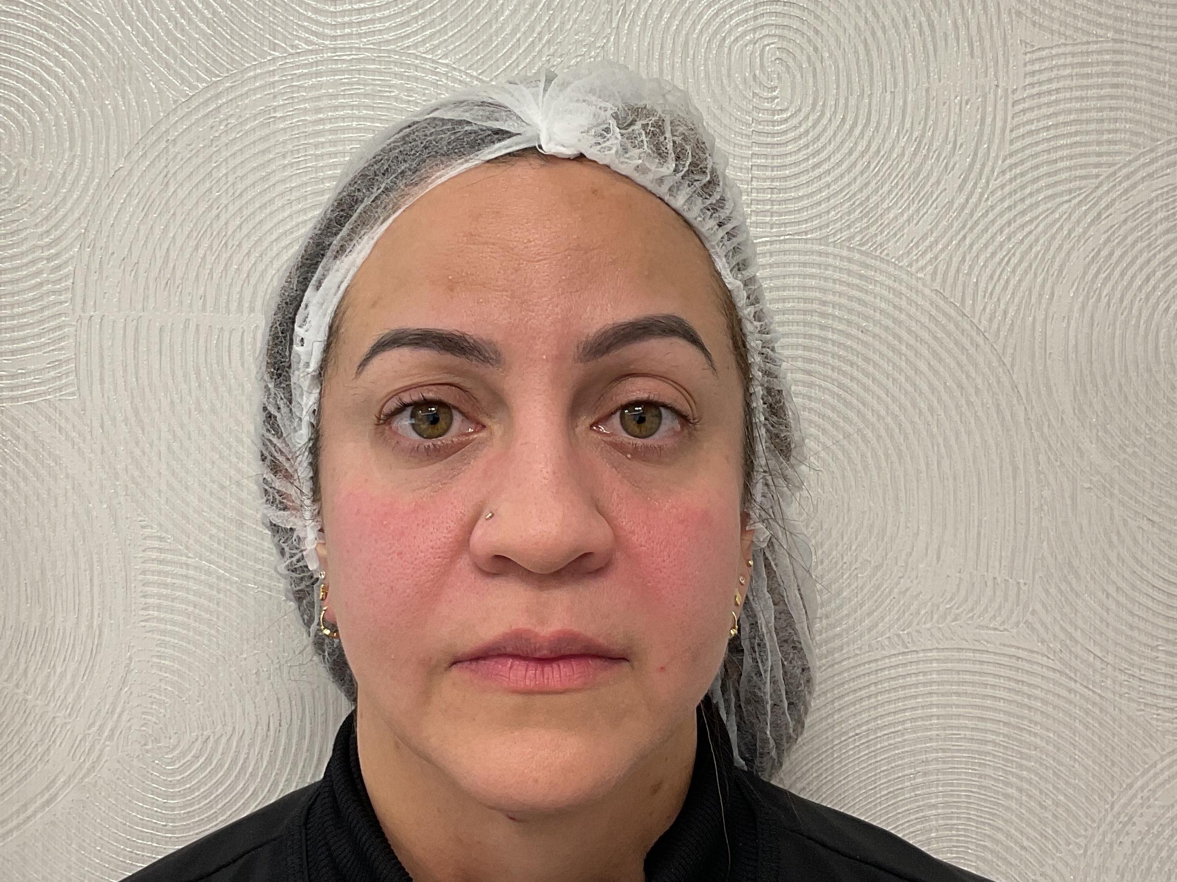 Sculptra, surco nasogeniano-after