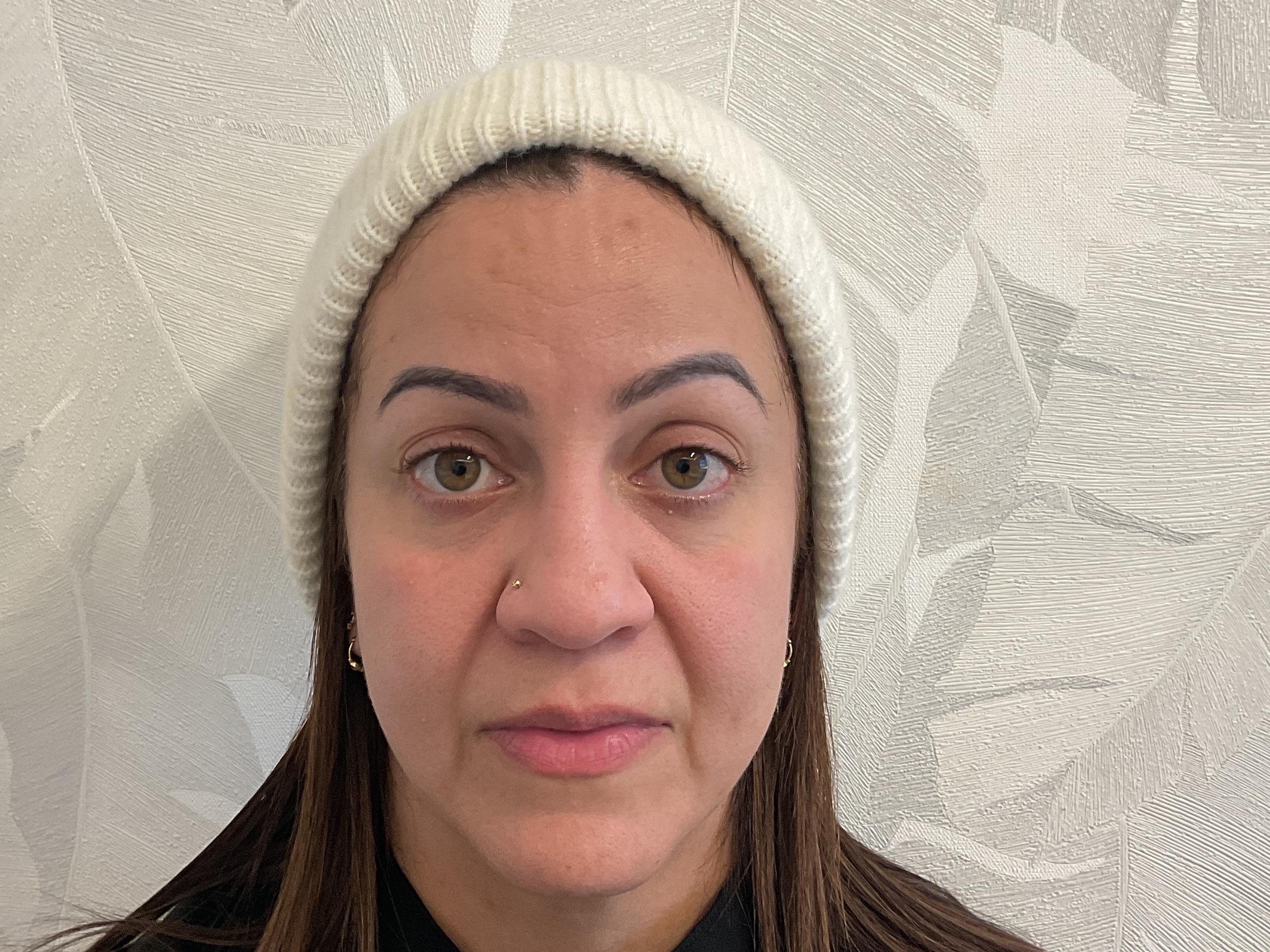 Sculptra, surco nasogeniano-before