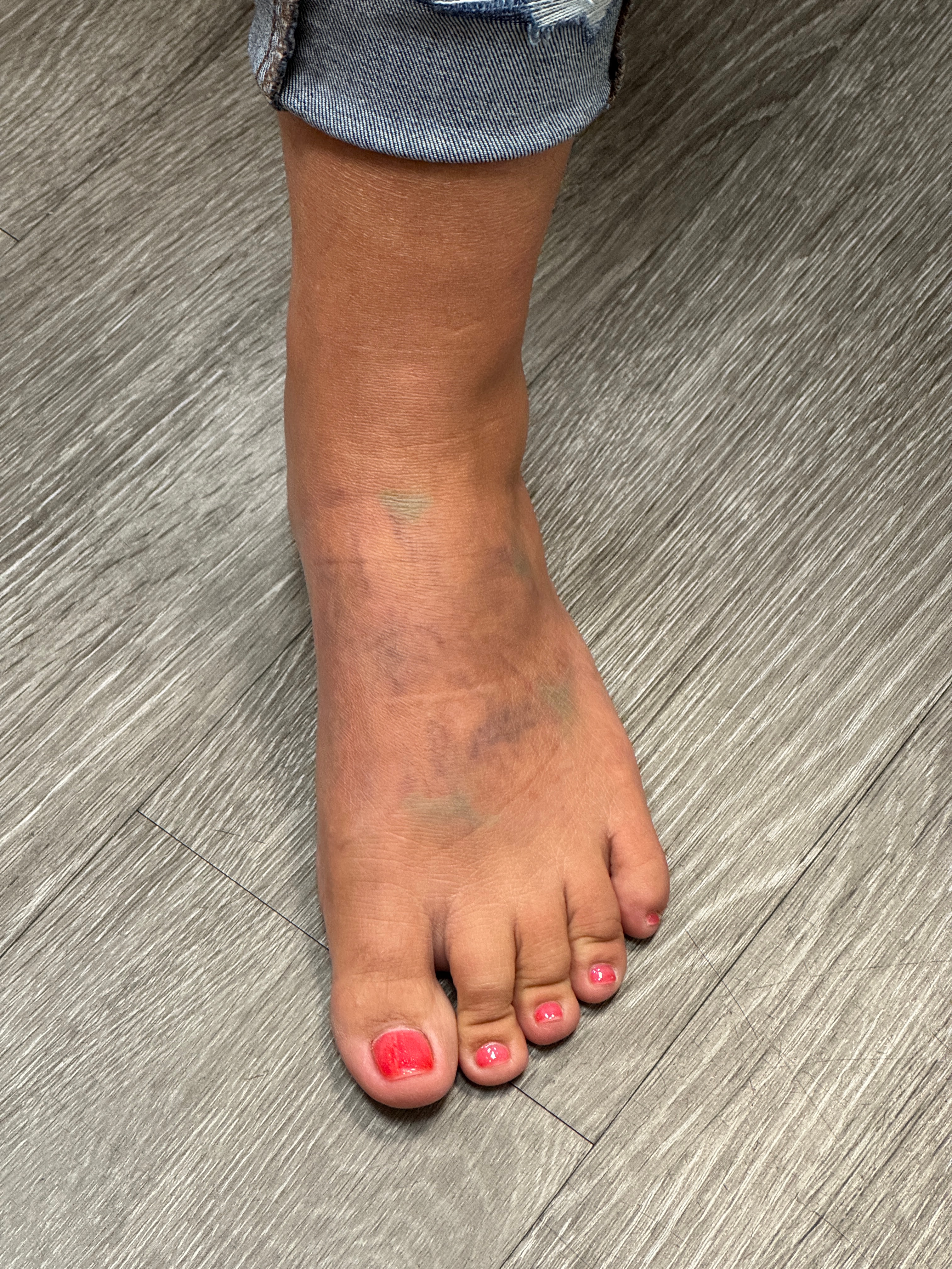 Ashley Reich RN. - 11 Treatments (Cover-up)-after