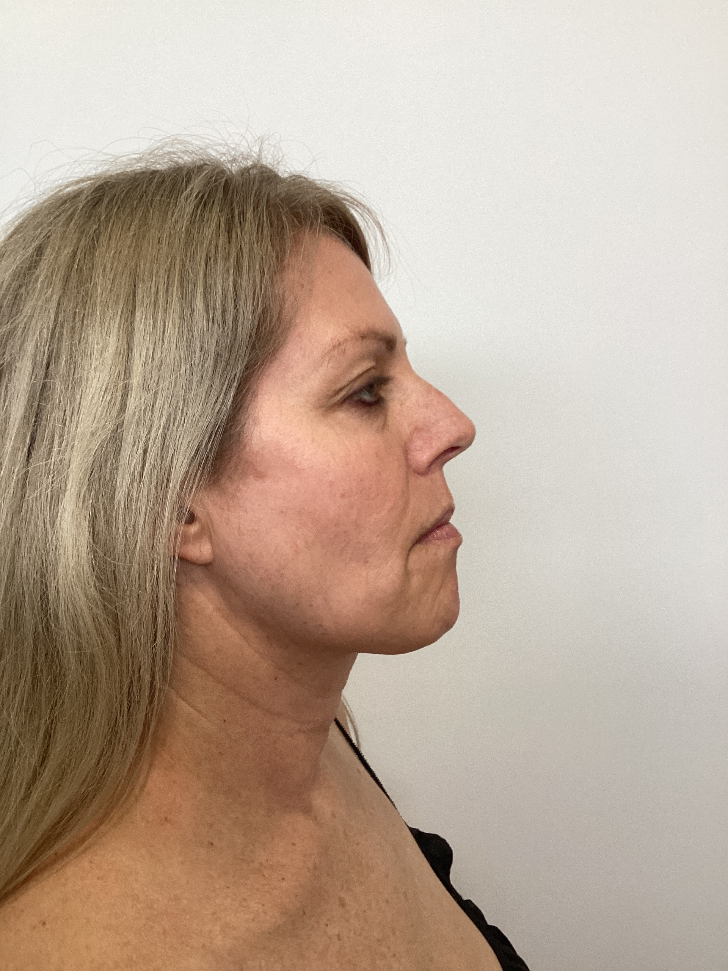 Cryo Facial 1 Session-before