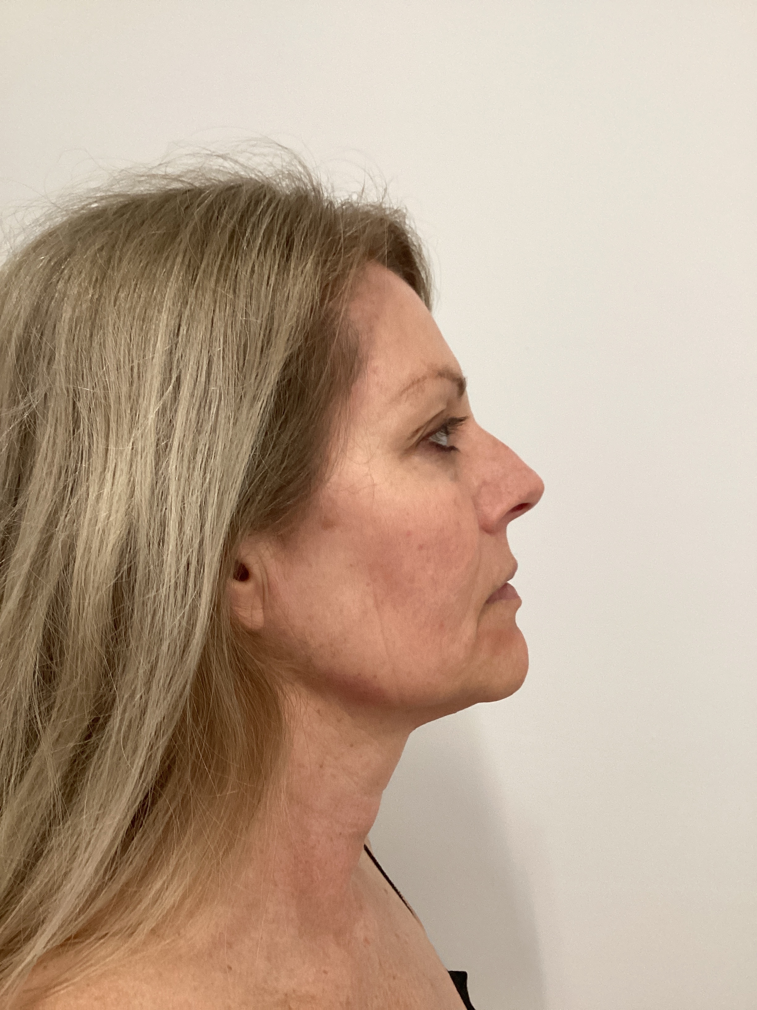 Cryo Facial 1 Session-after