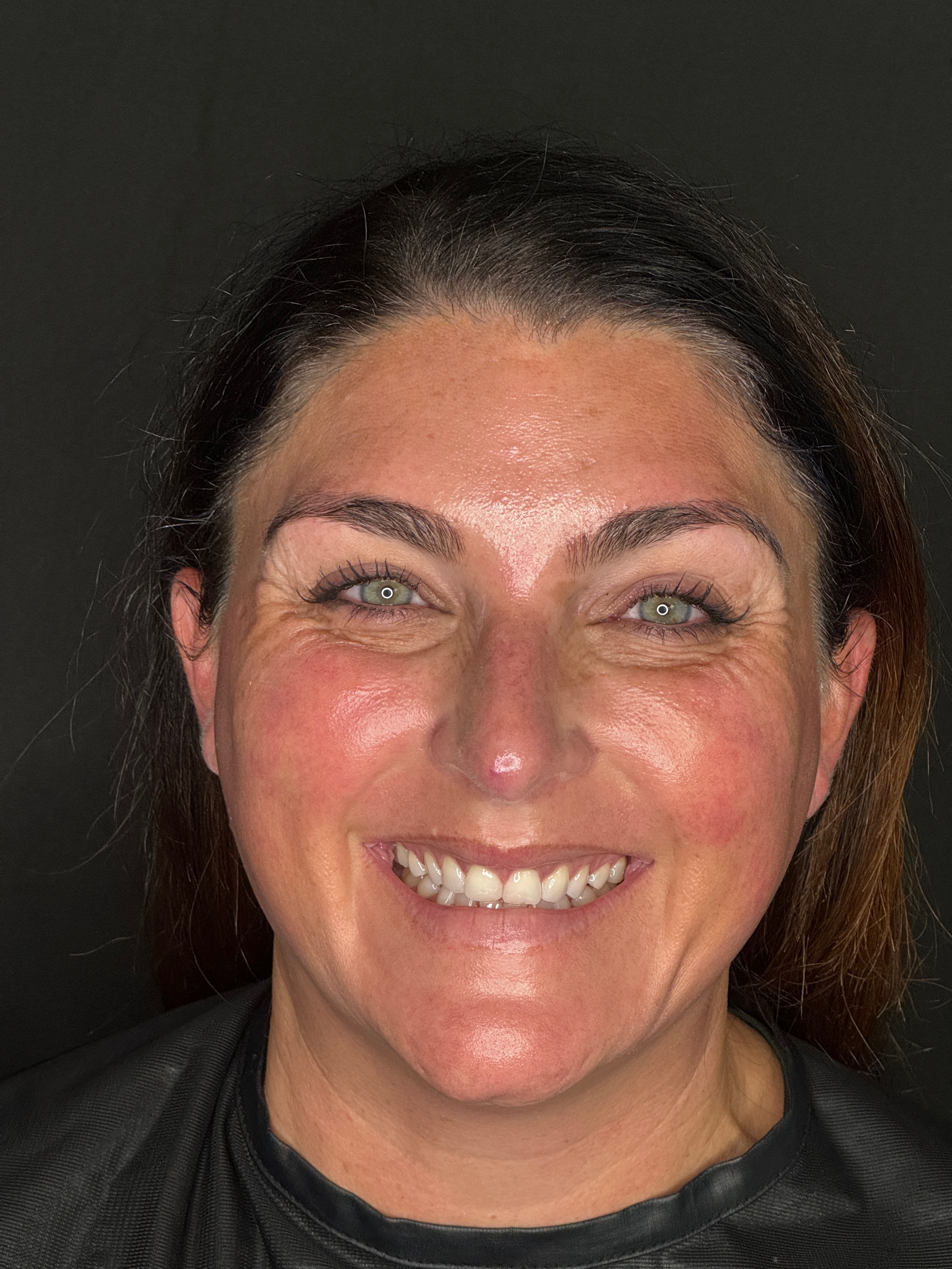 Ashley Reich RN - Botox - Crows Feet-before