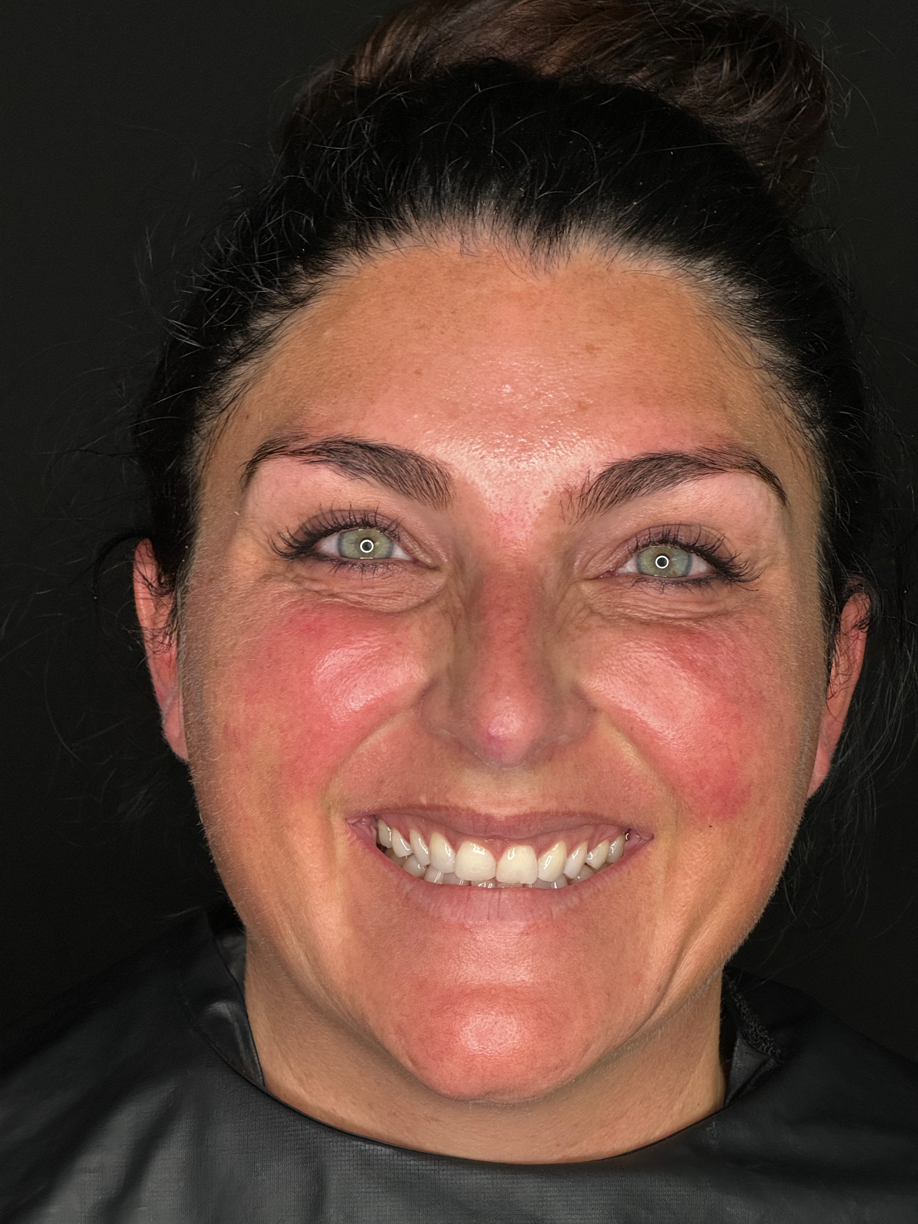 Ashley Reich RN - Botox - Crows Feet-after