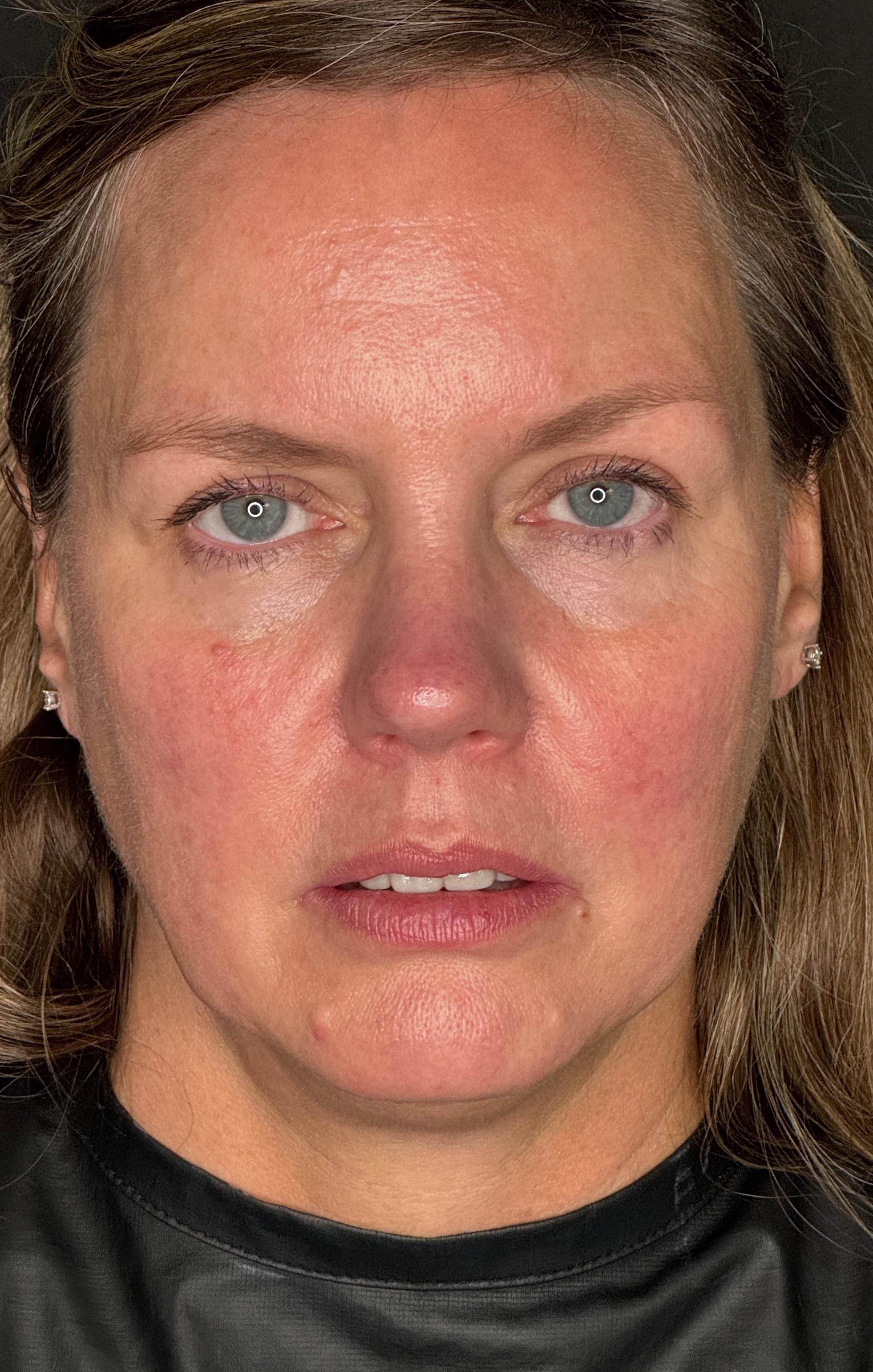 Ashley Reich, RN. - BBL-before