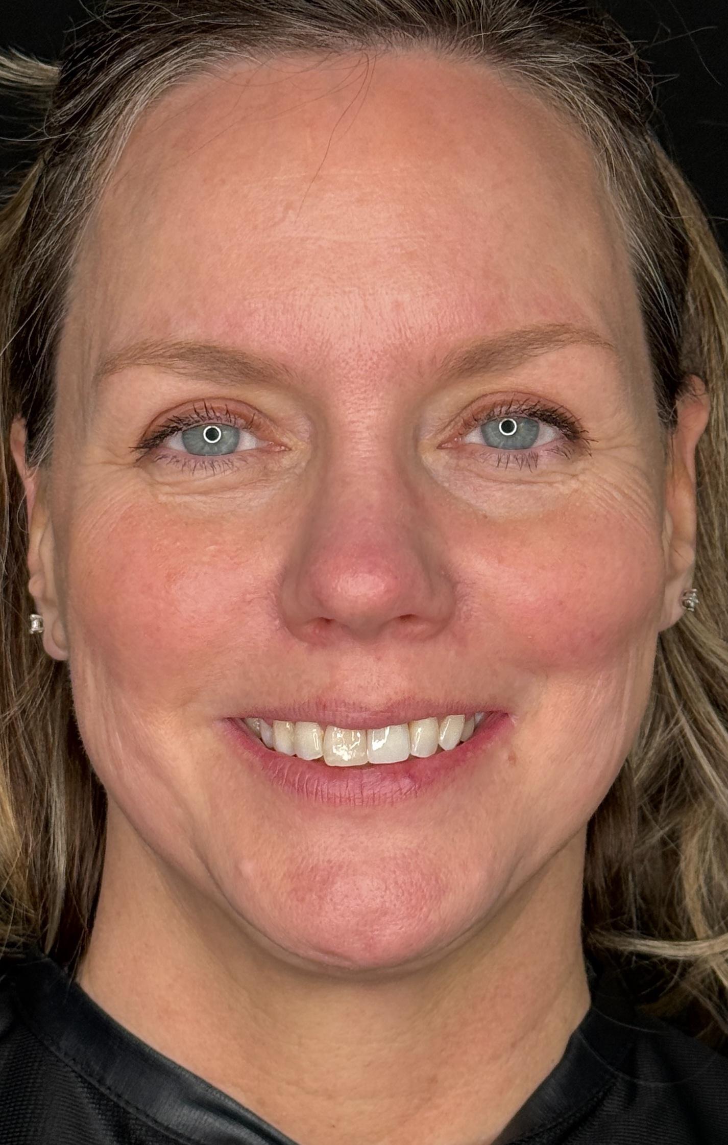 Ashley Reich, RN. - BBL-after