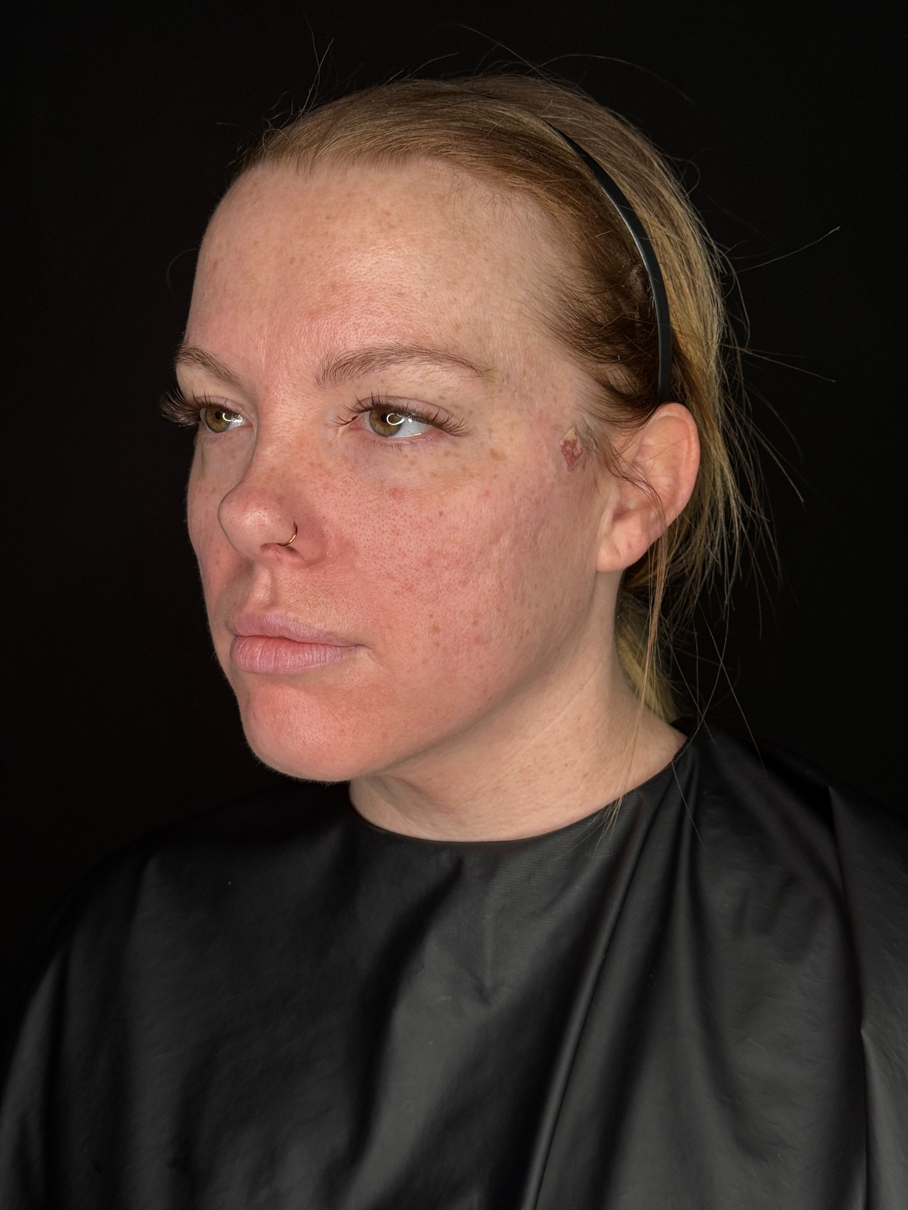 Danielle Glass RN - Lower Face Threads-after