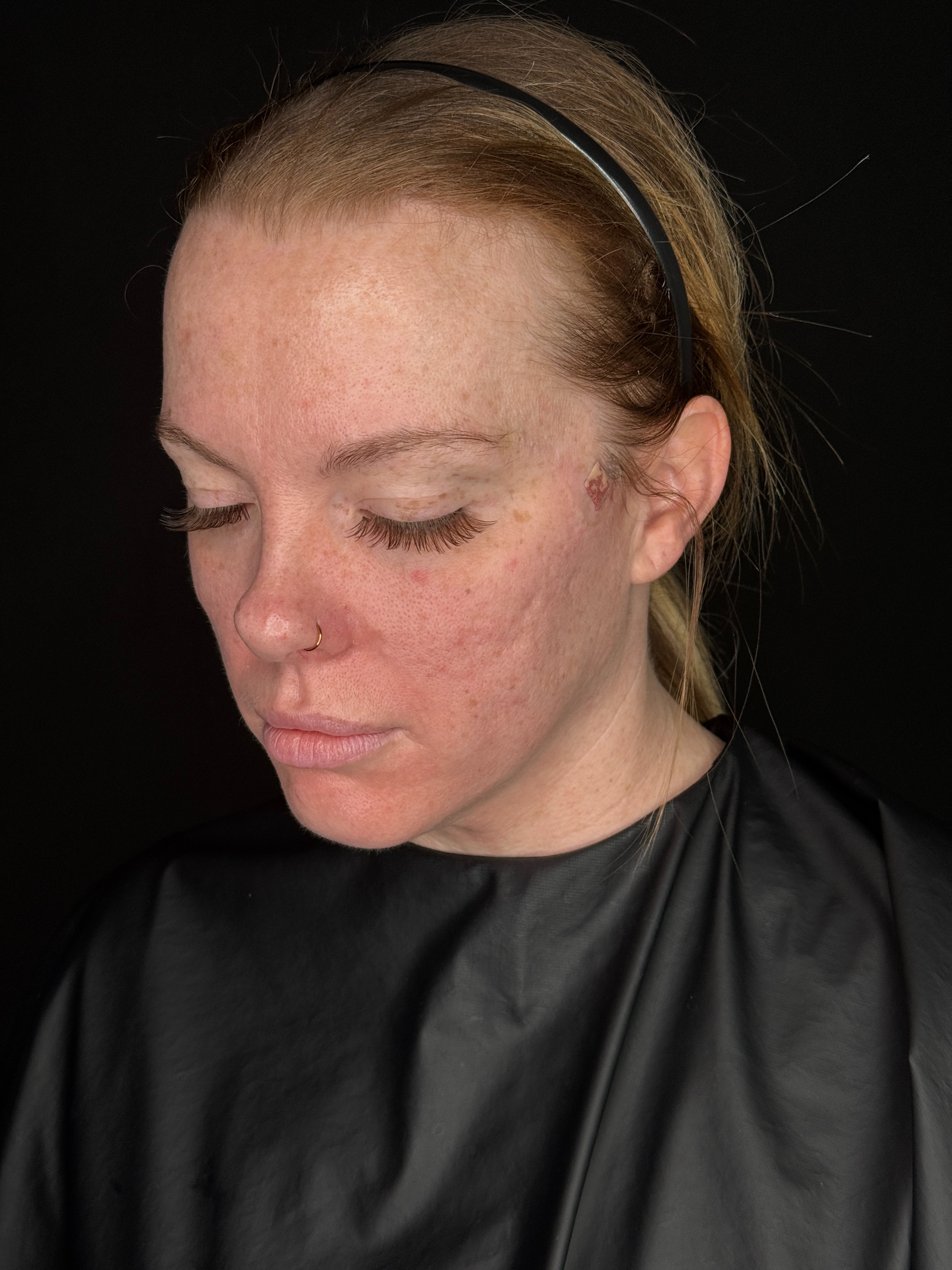 Danielle Glass RN - Lower Face Threads-after