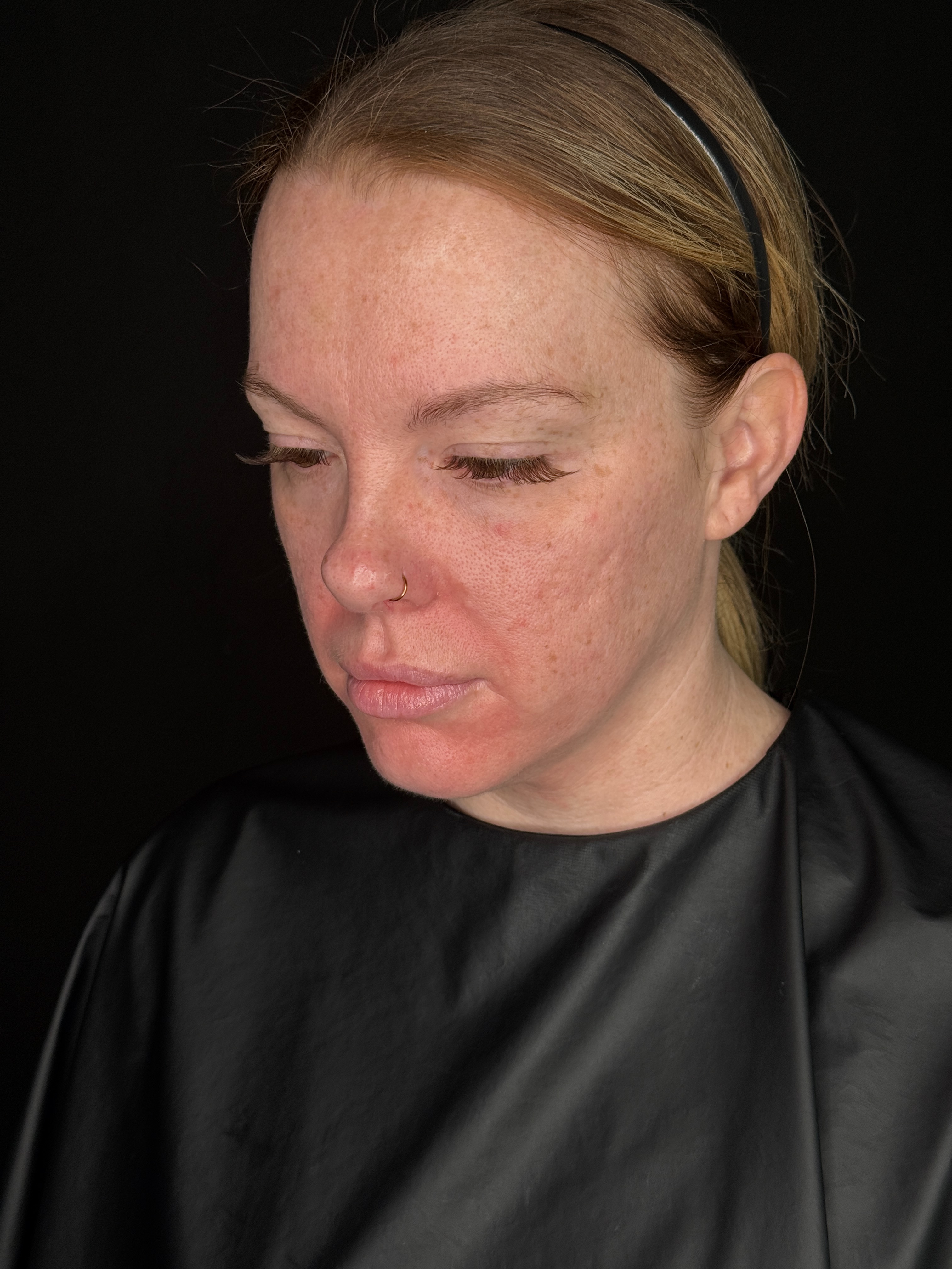 Danielle Glass RN - Lower Face Threads-before