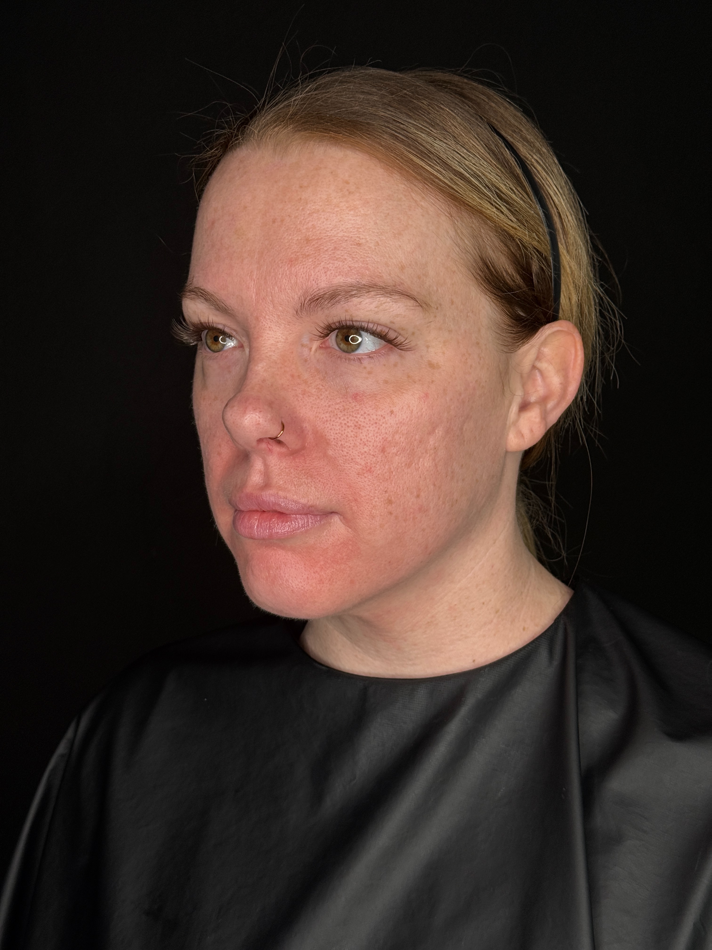 Danielle Glass RN - Lower Face Threads-before