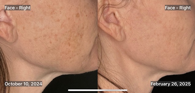 BBL Series - Ashley Reich, RN-after