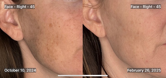 BBL Series - Ashley Reich, RN-before