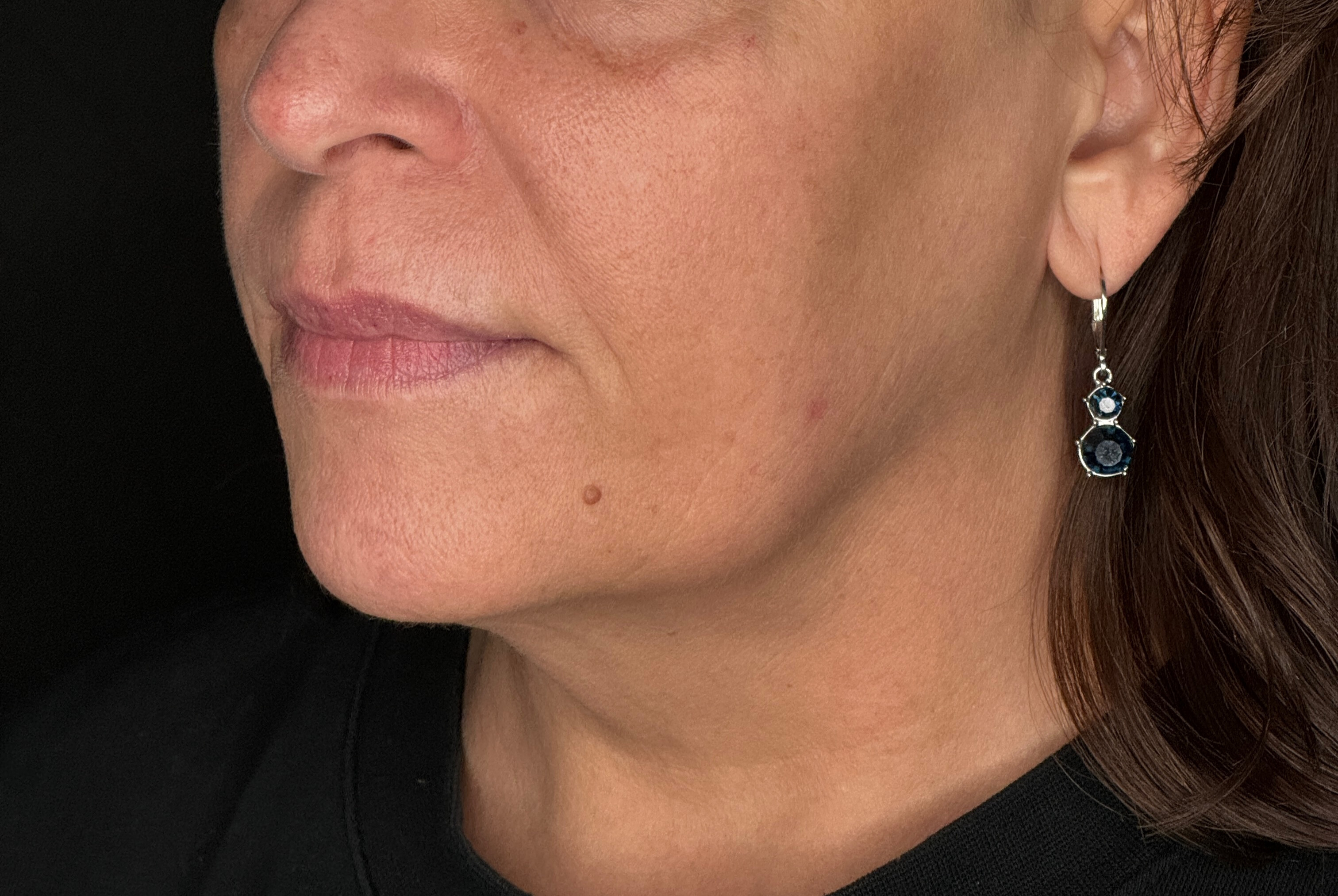 Exilis Full Face and Neck - Ashley Reich RN-after
