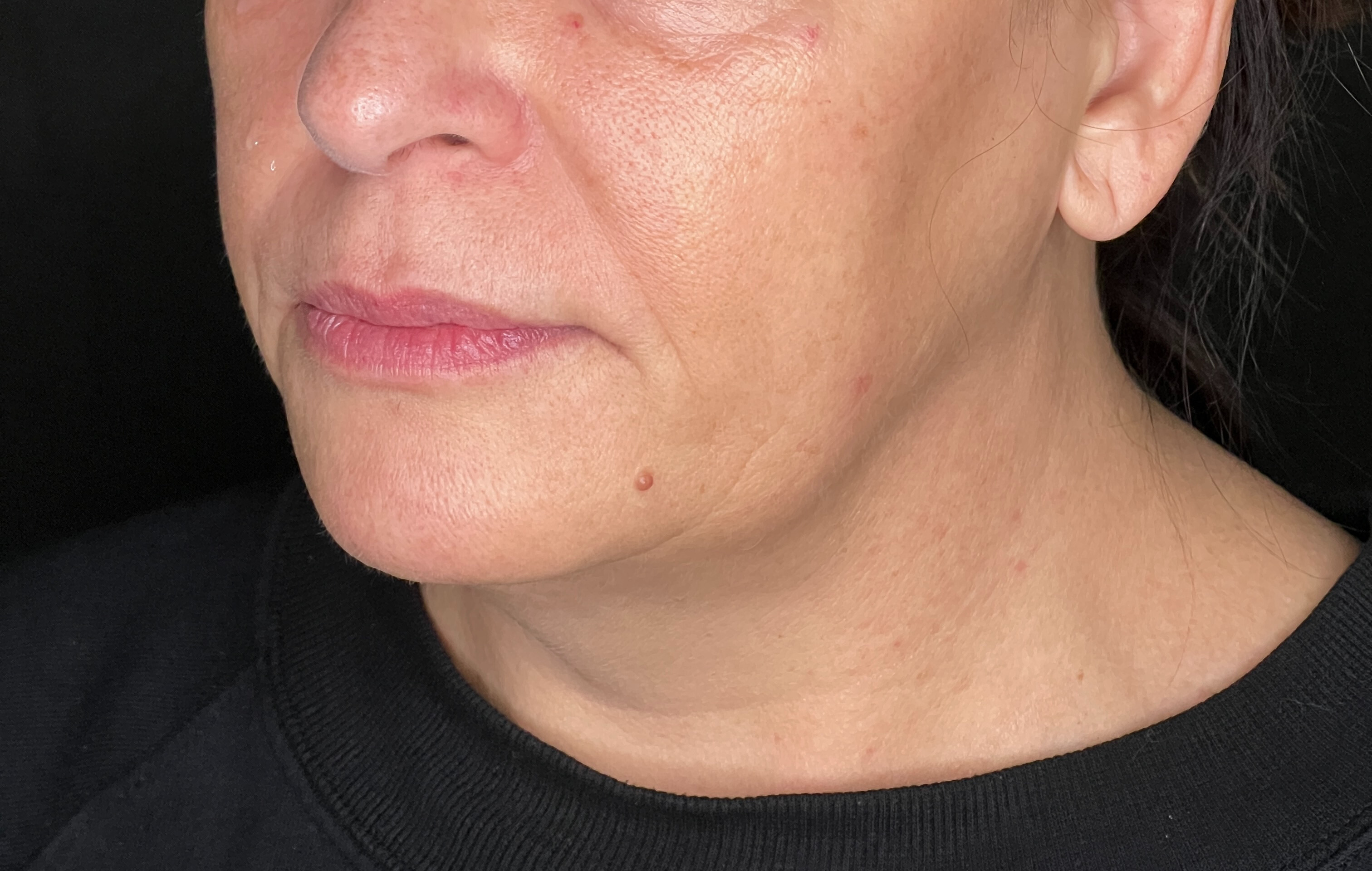 Exilis Full Face and Neck - Ashley Reich RN-before