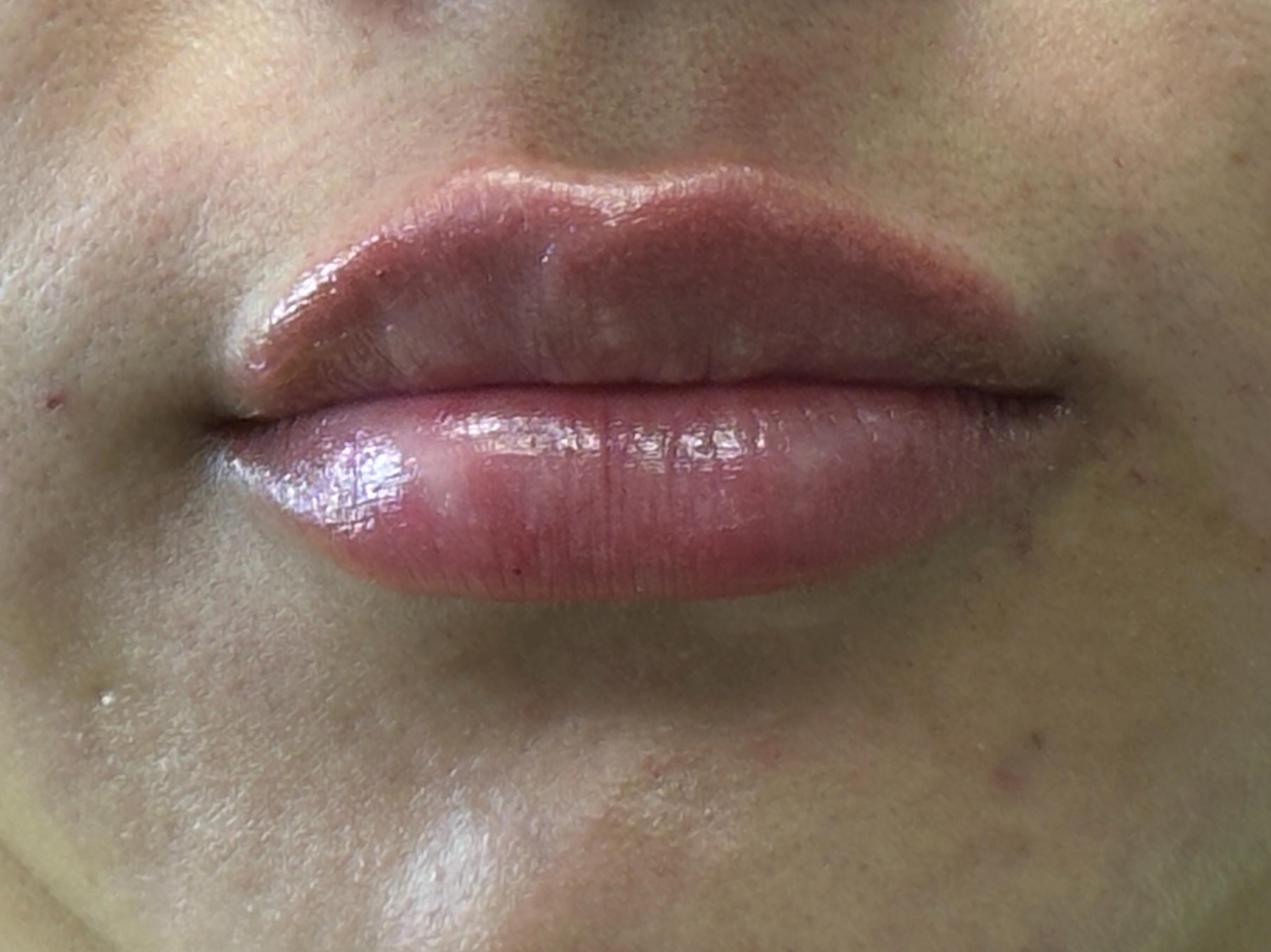 1 Syringe of Restylane-after