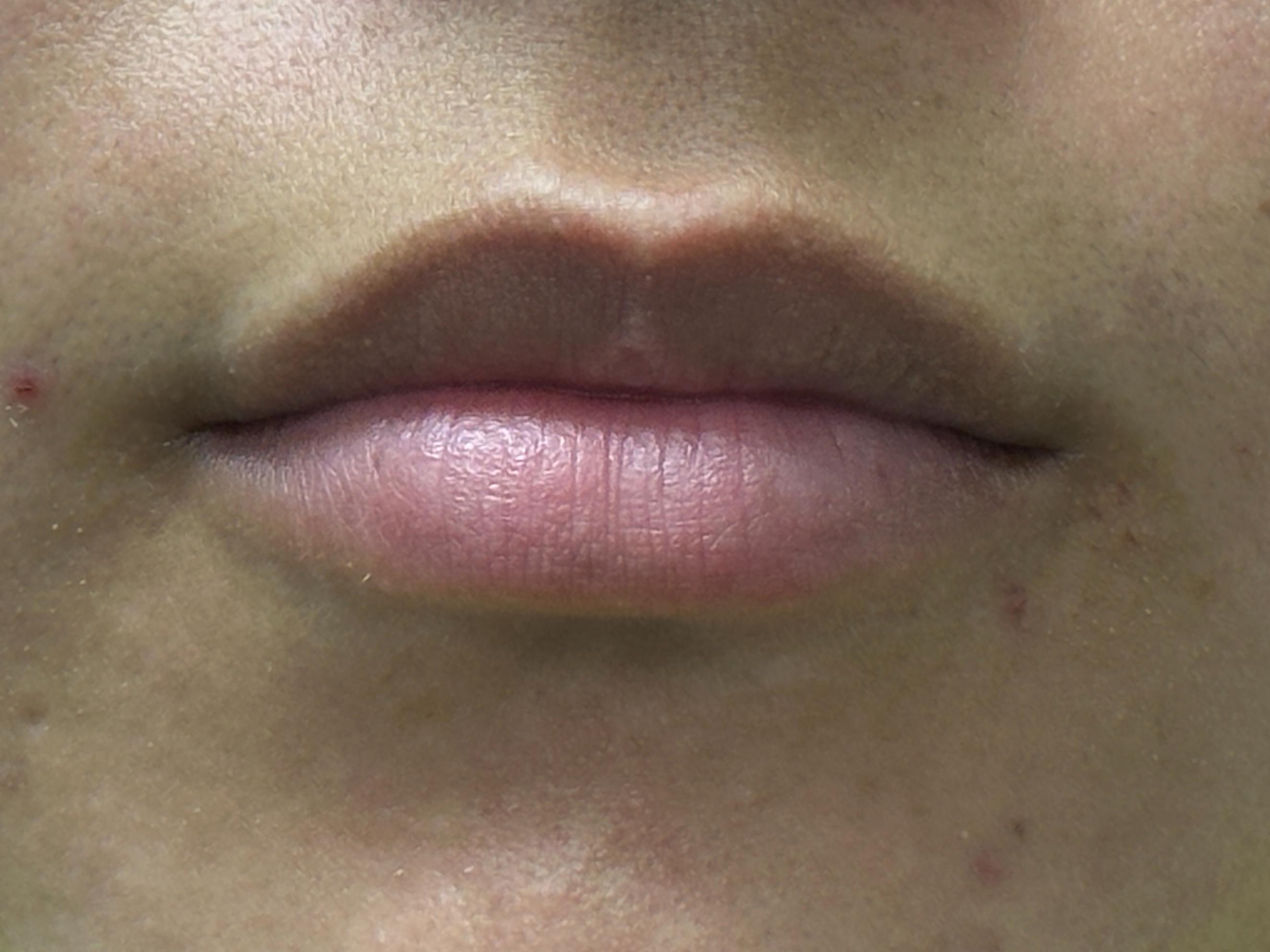 1 Syringe of Restylane-before