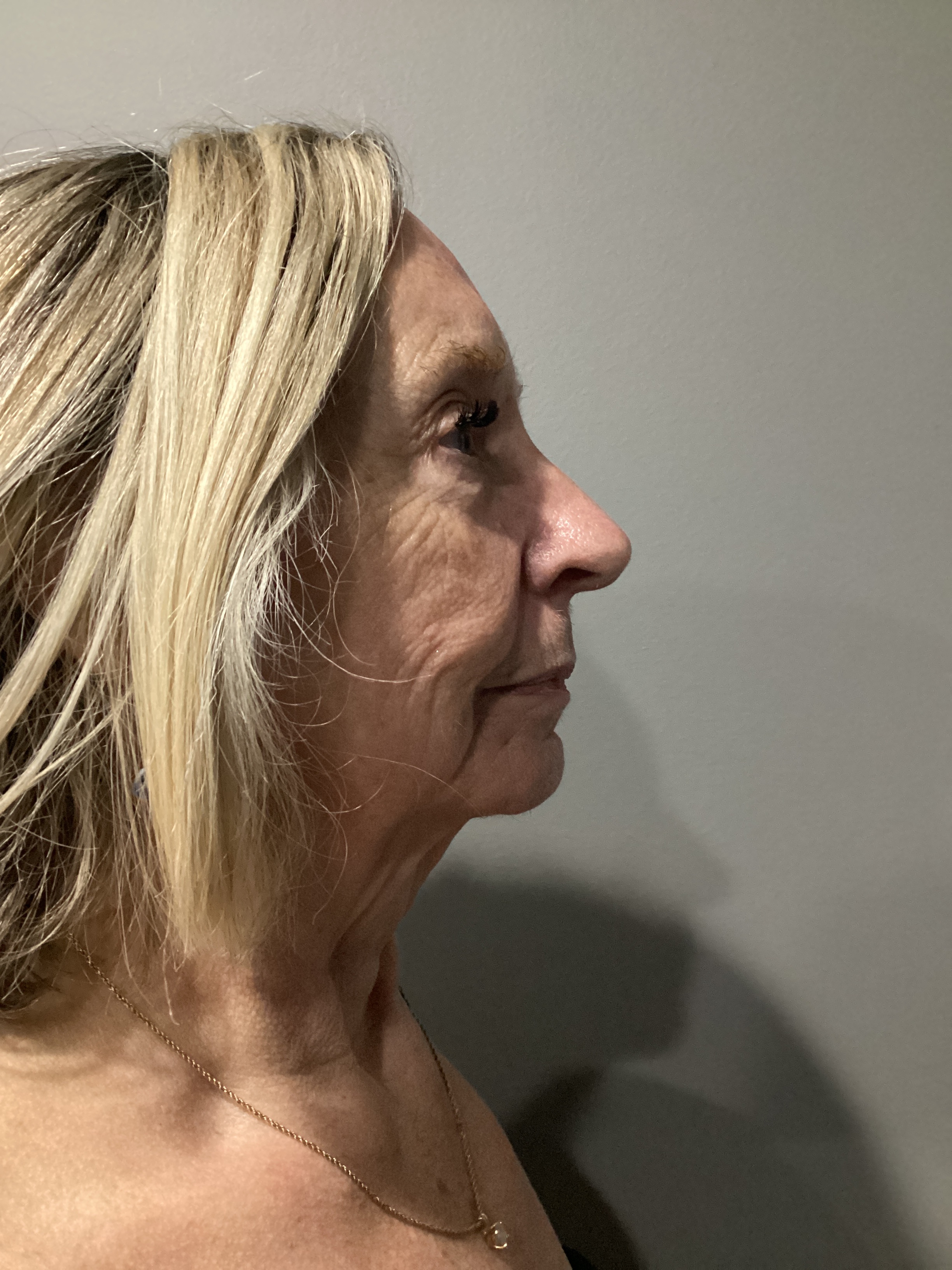 1 Endo Facial-before