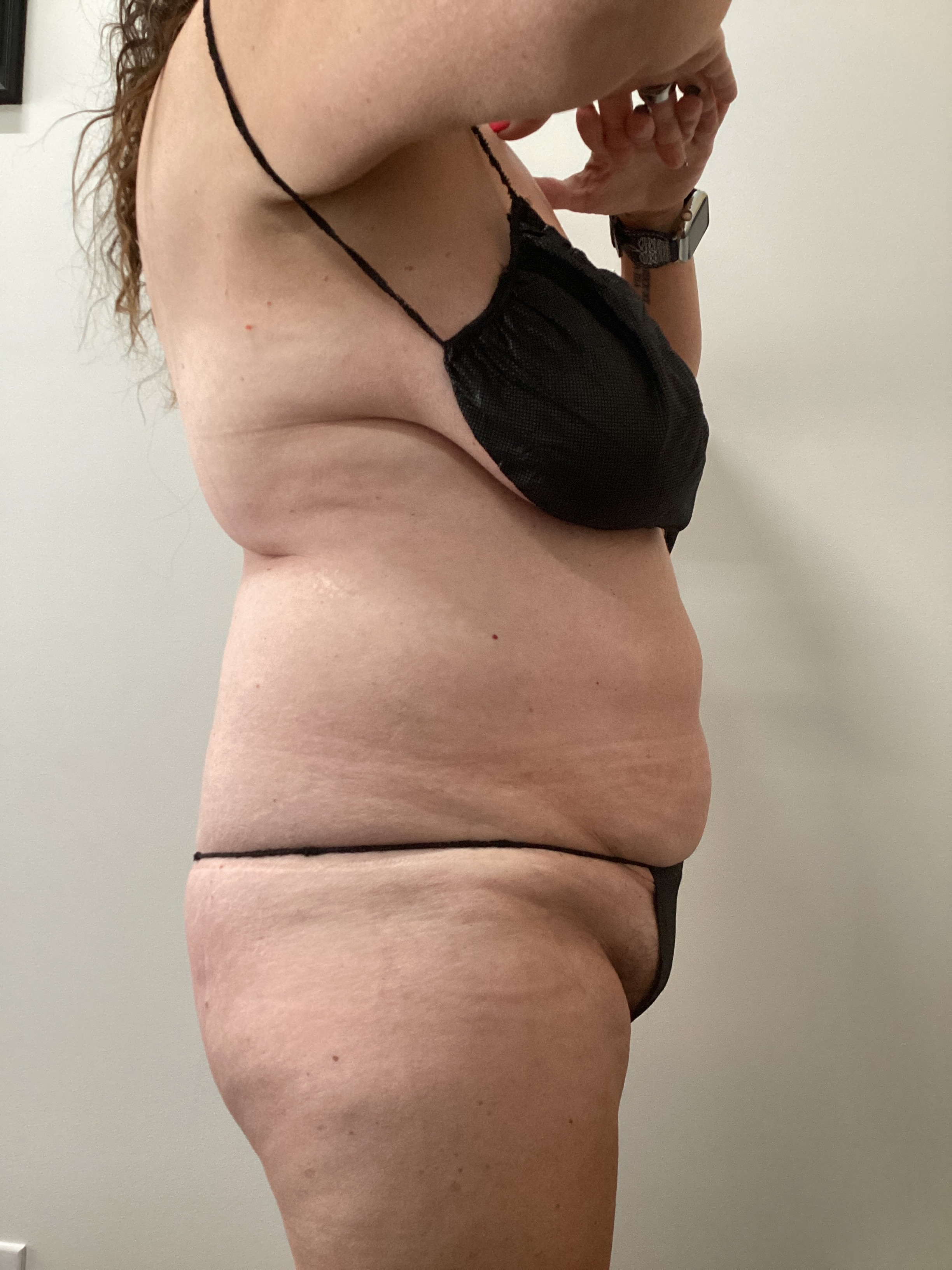 1 - Body treatment-after