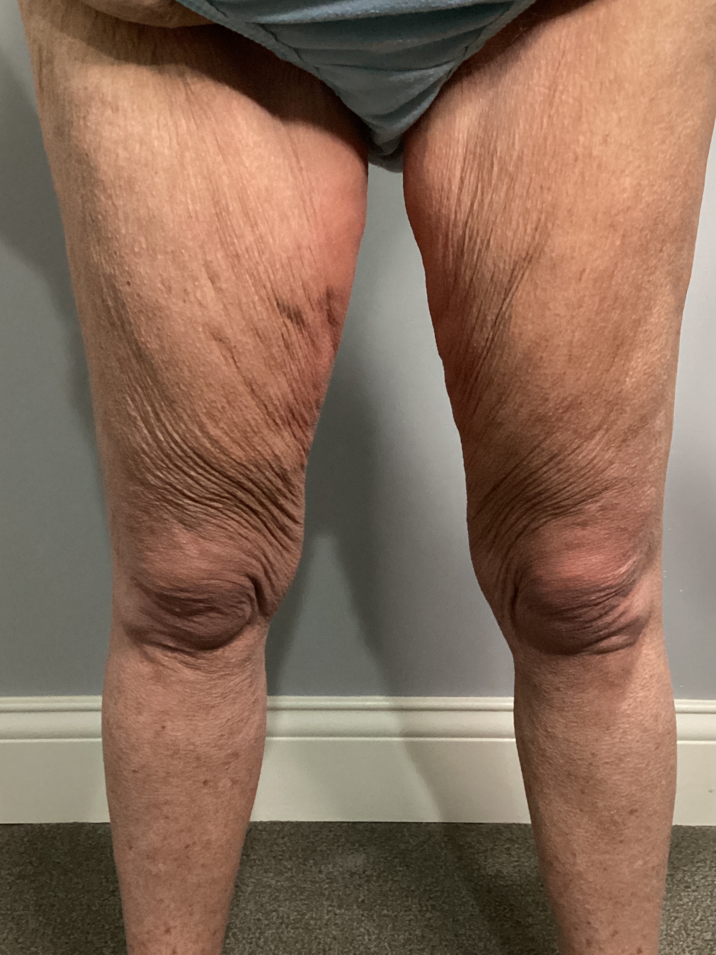 2- Endosphere-before