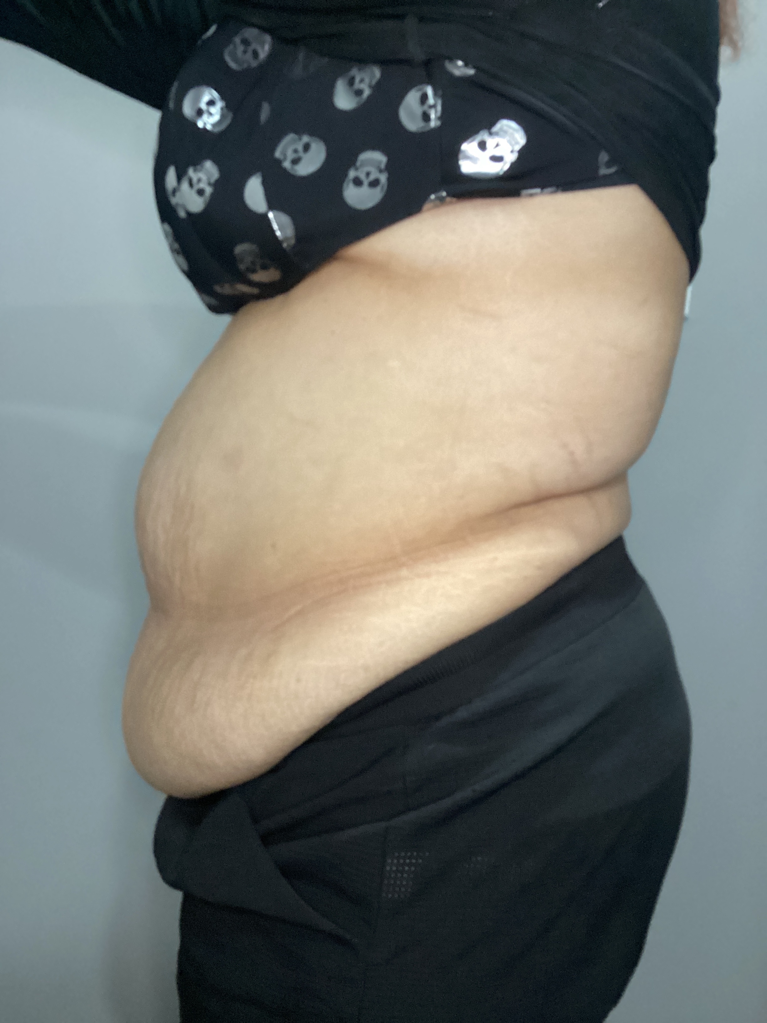 5 treatments and weight loss shots-after