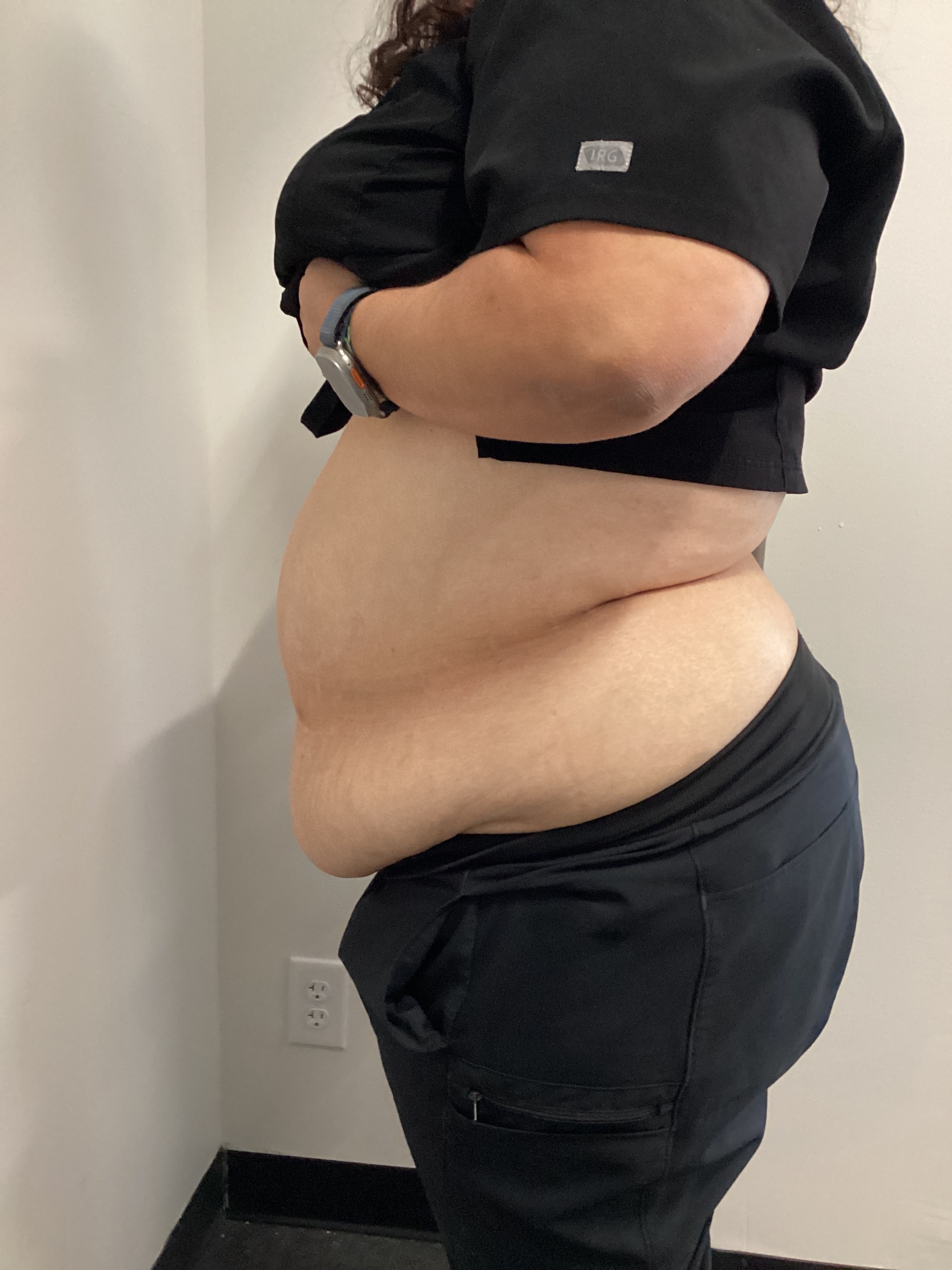 5 treatments and weight loss shots-before